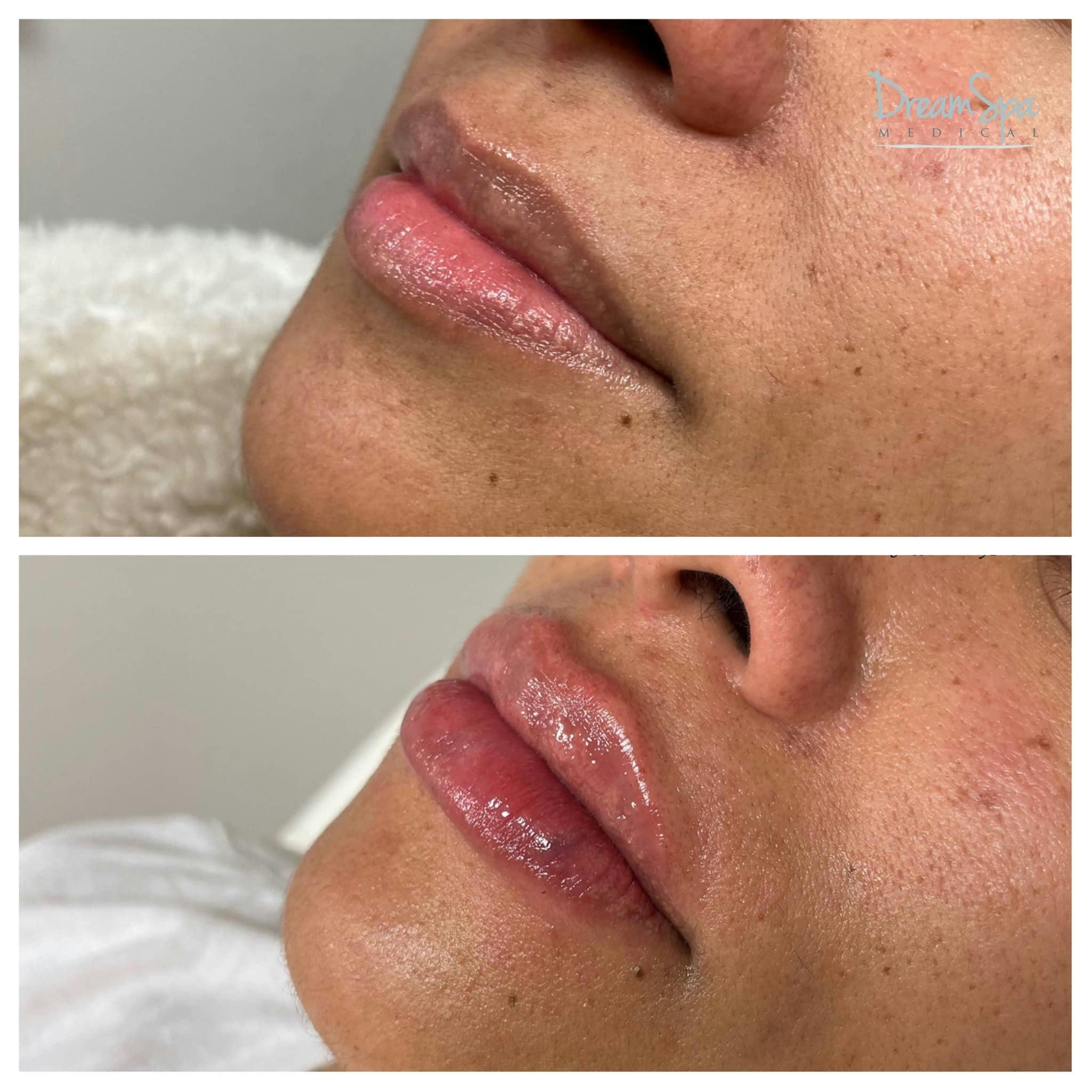 Lip Filler Before & After Gallery - Patient 118351199 - Image 1