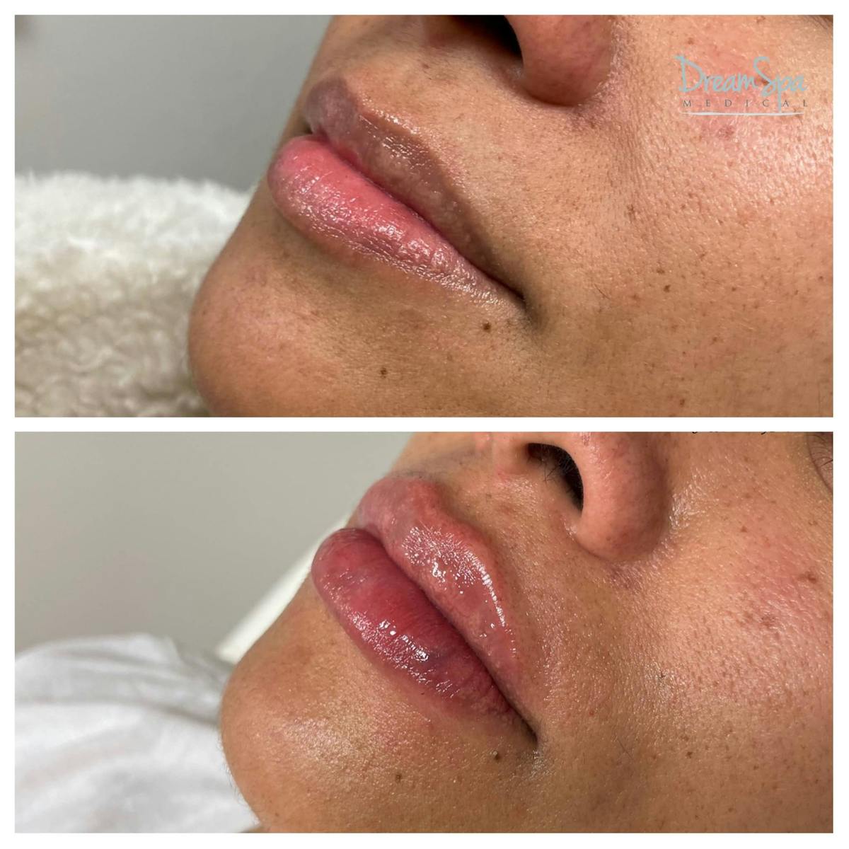 Lip Filler Before & After Gallery - Patient 118351199 - Image 1