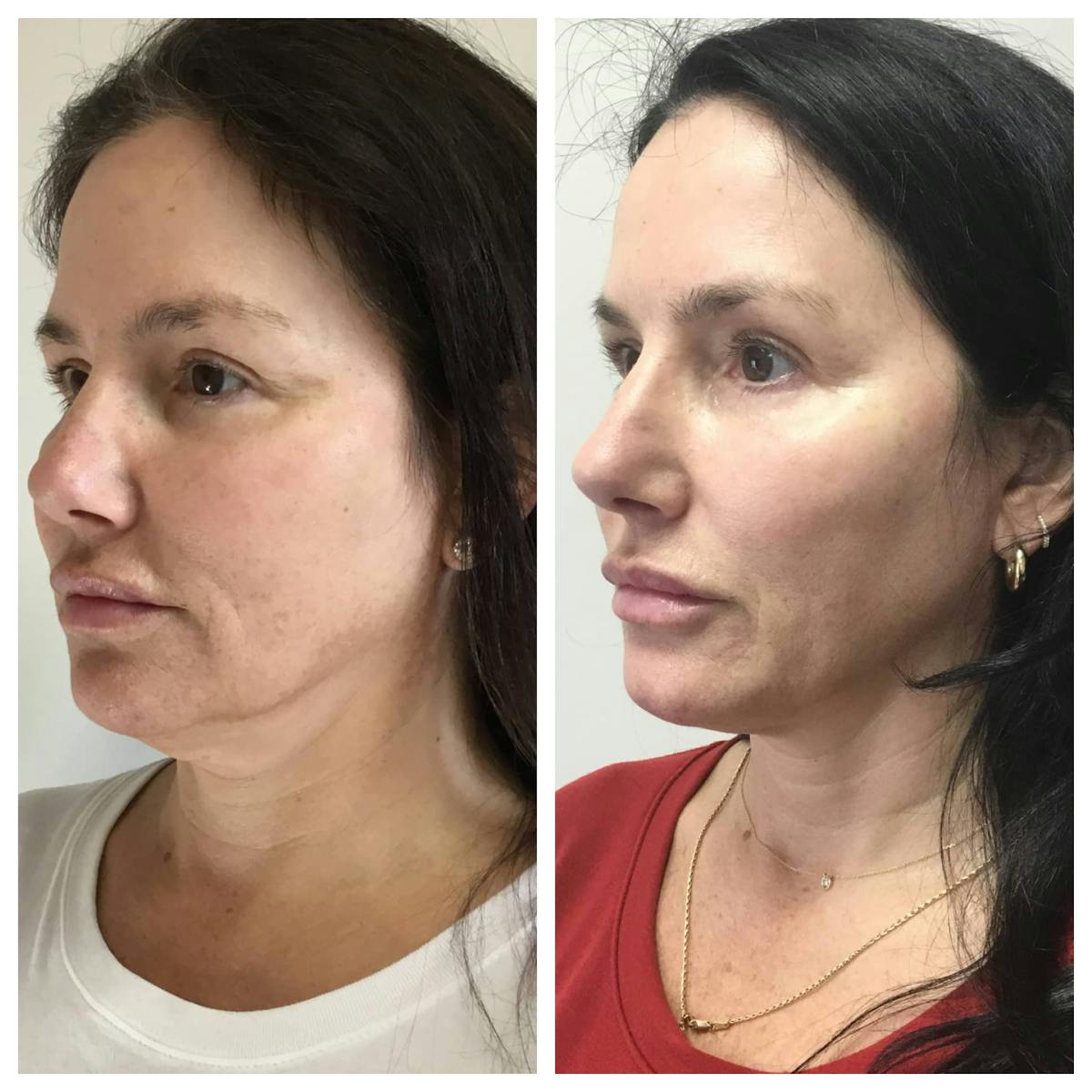 Ultherapy Before & After Gallery - Patient 118352055 - Image 1