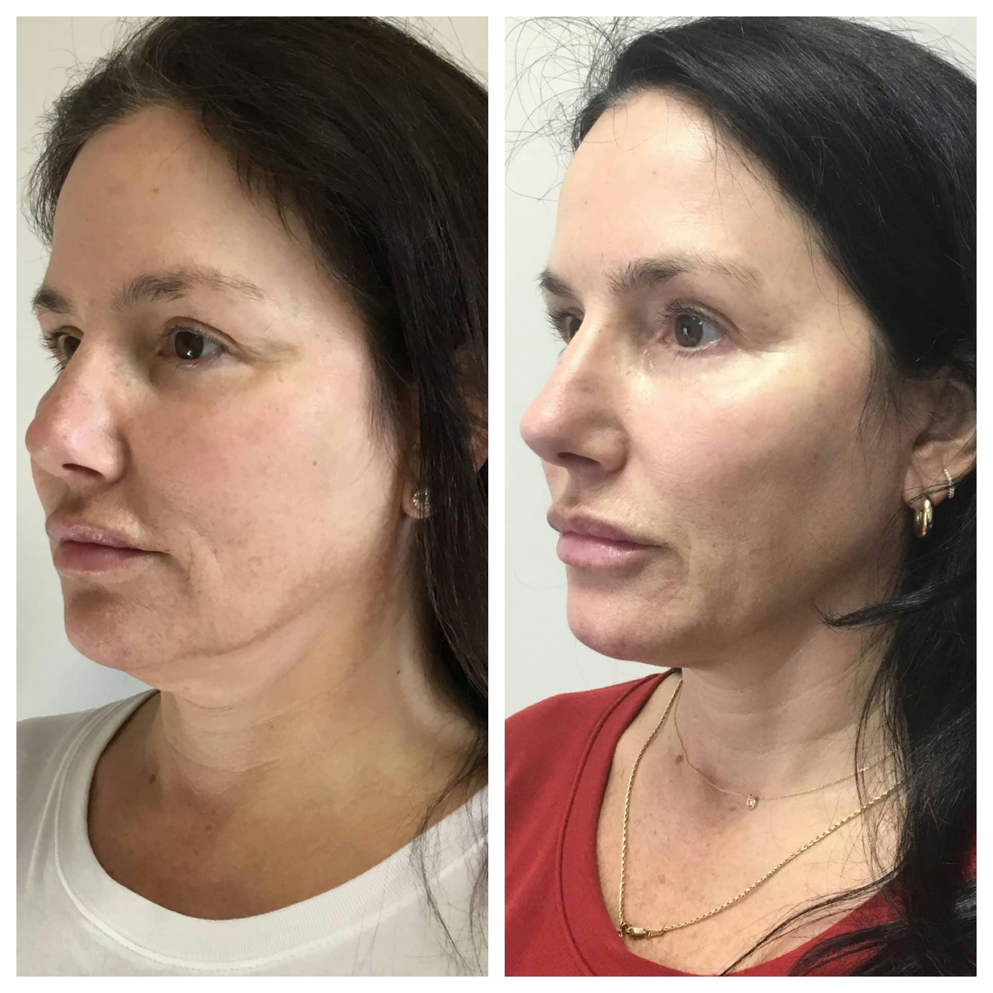 Ultherapy Before & After Gallery - Patient 118352055 - Image 1