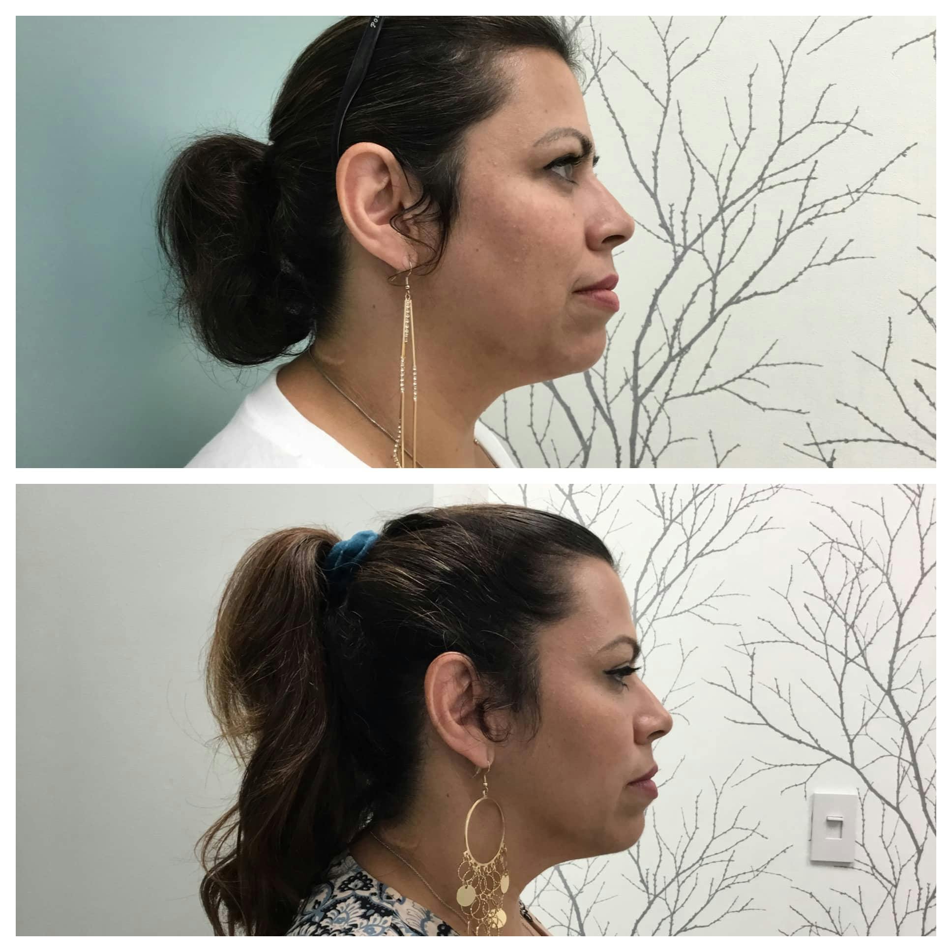 Ultherapy Before & After Gallery - Patient 118352056 - Image 1