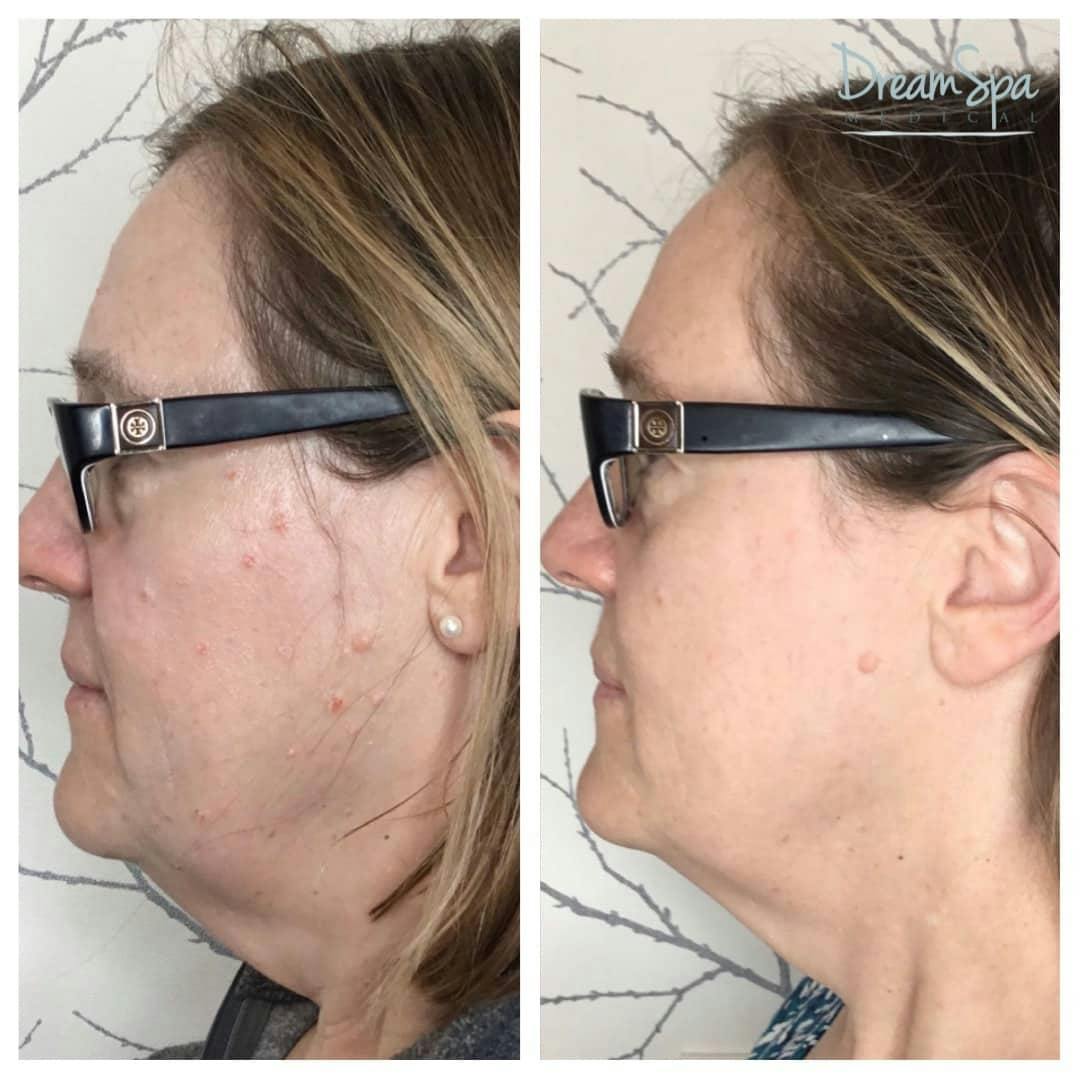 Ultherapy Before & After Gallery - Patient 118352057 - Image 1