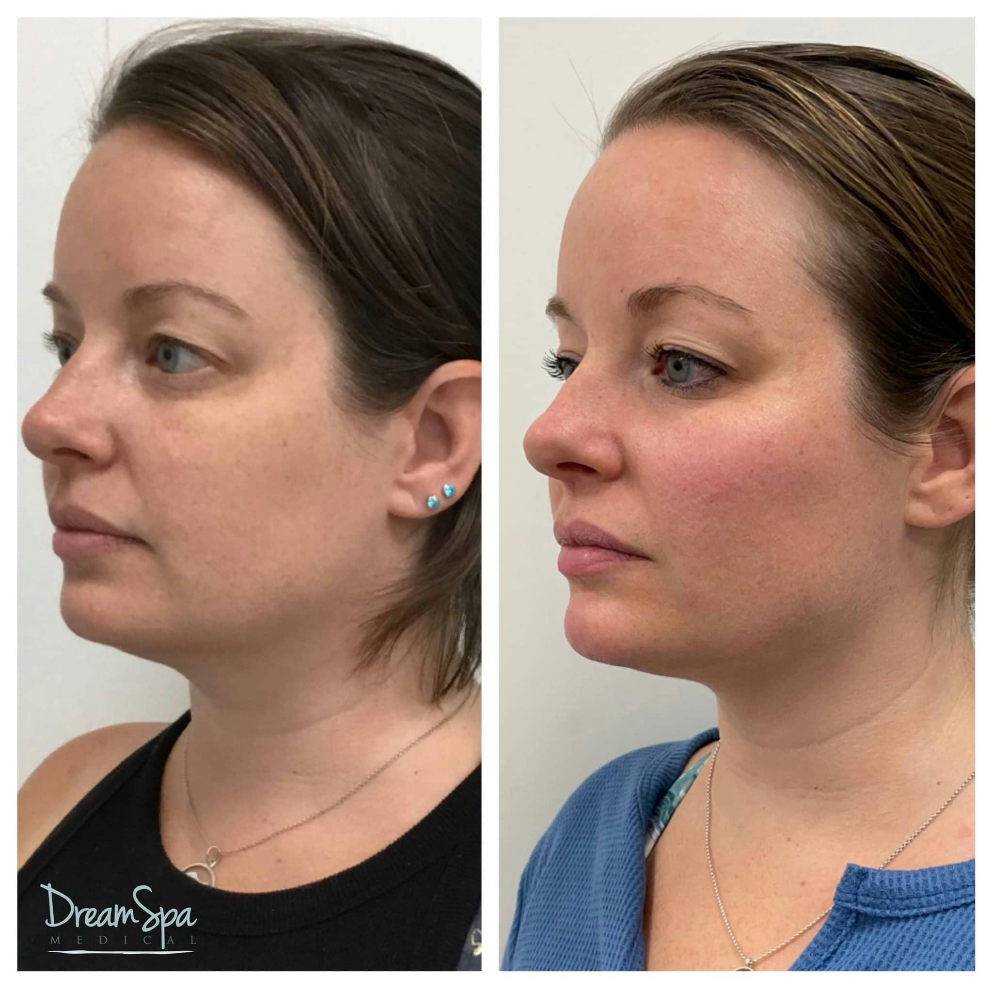 Ultherapy Before & After Gallery - Patient 118352058 - Image 1