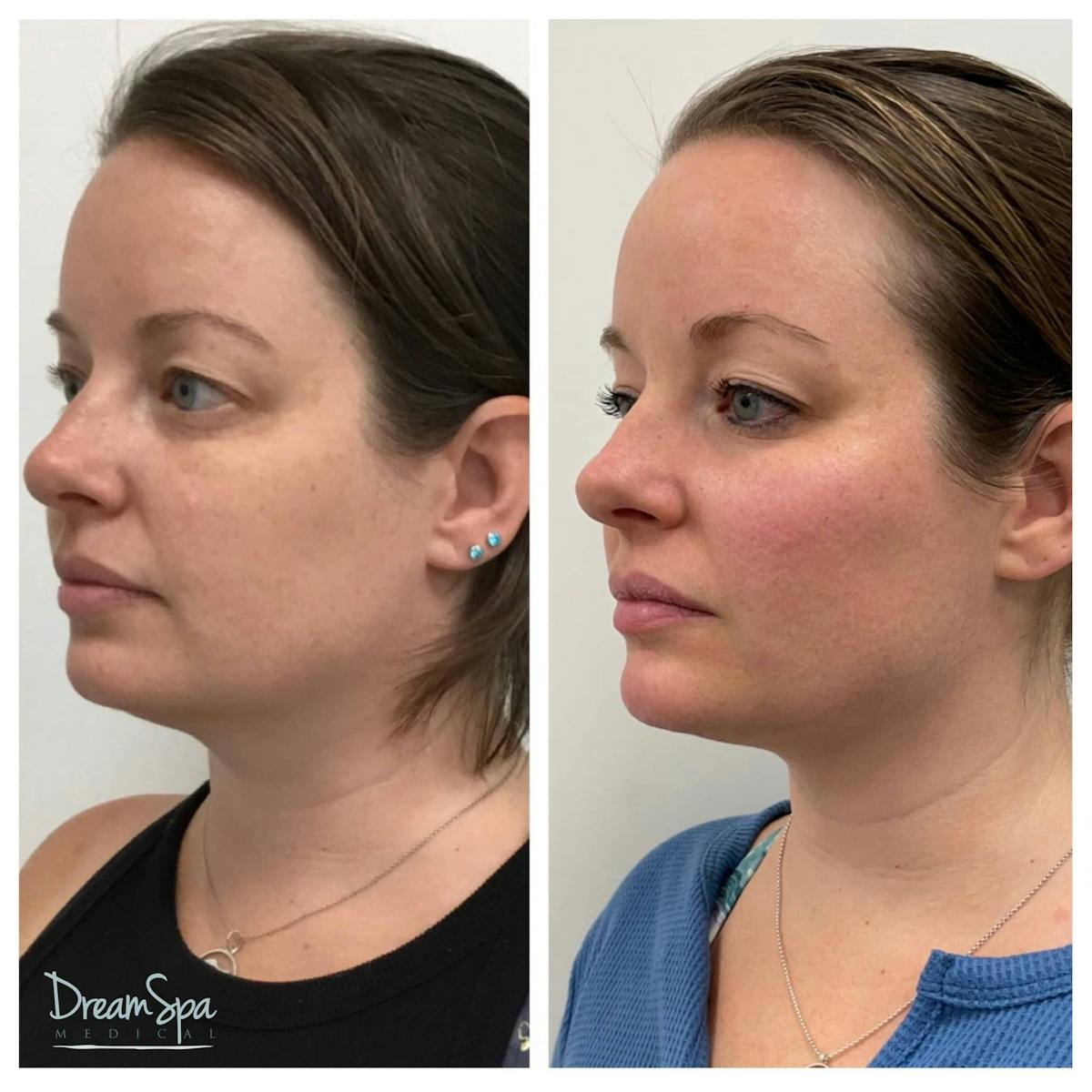 Ultherapy Before & After Gallery - Patient 118352058 - Image 1