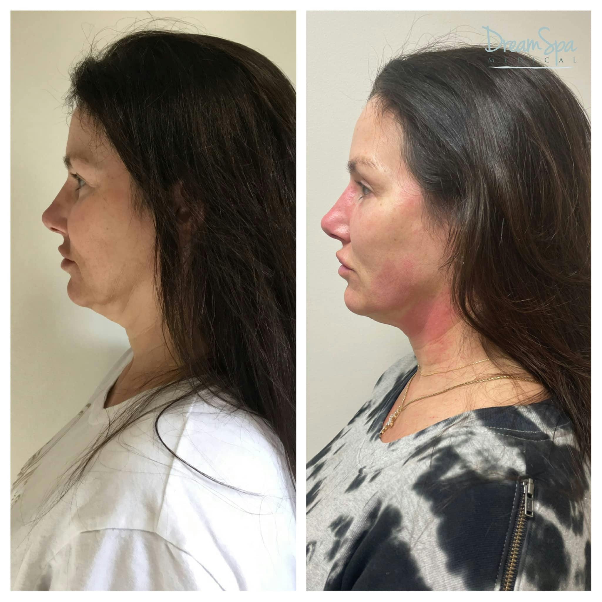 Ultherapy Before & After Gallery - Patient 118352059 - Image 1