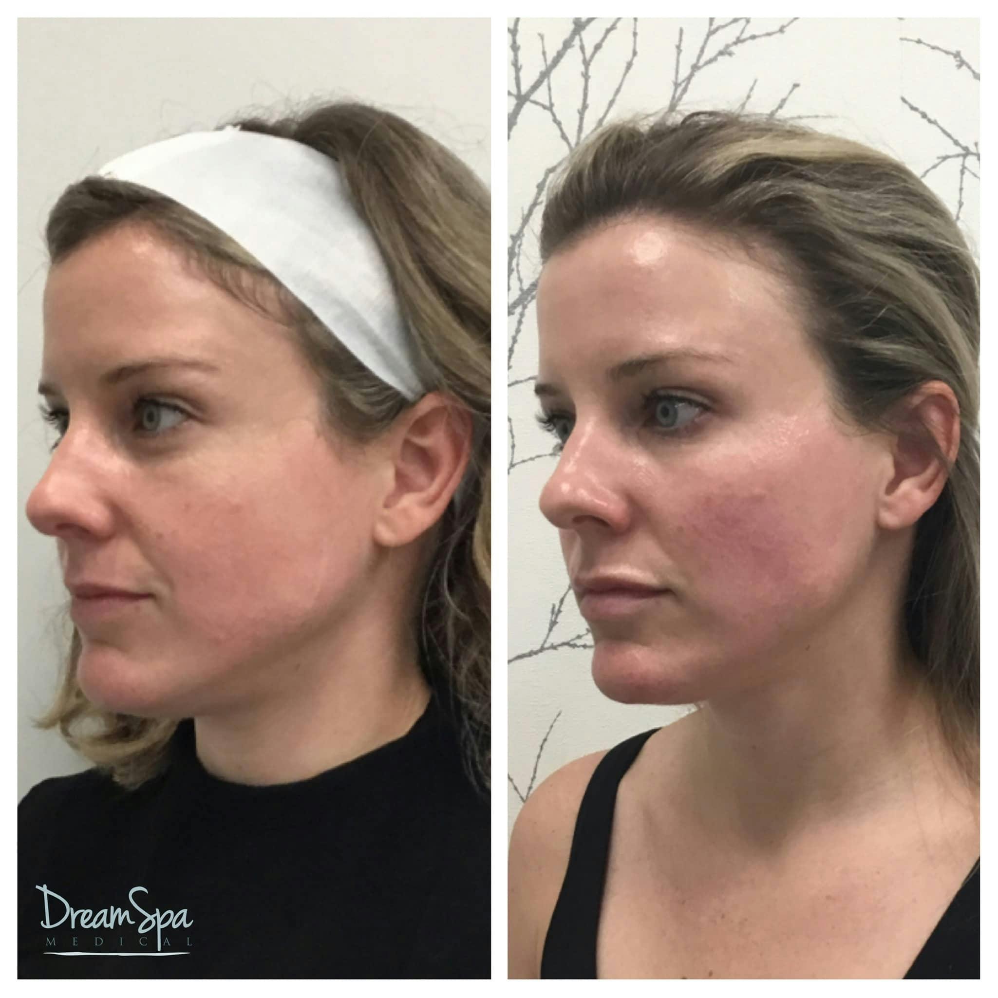 Ultherapy Before & After Gallery - Patient 118352060 - Image 1
