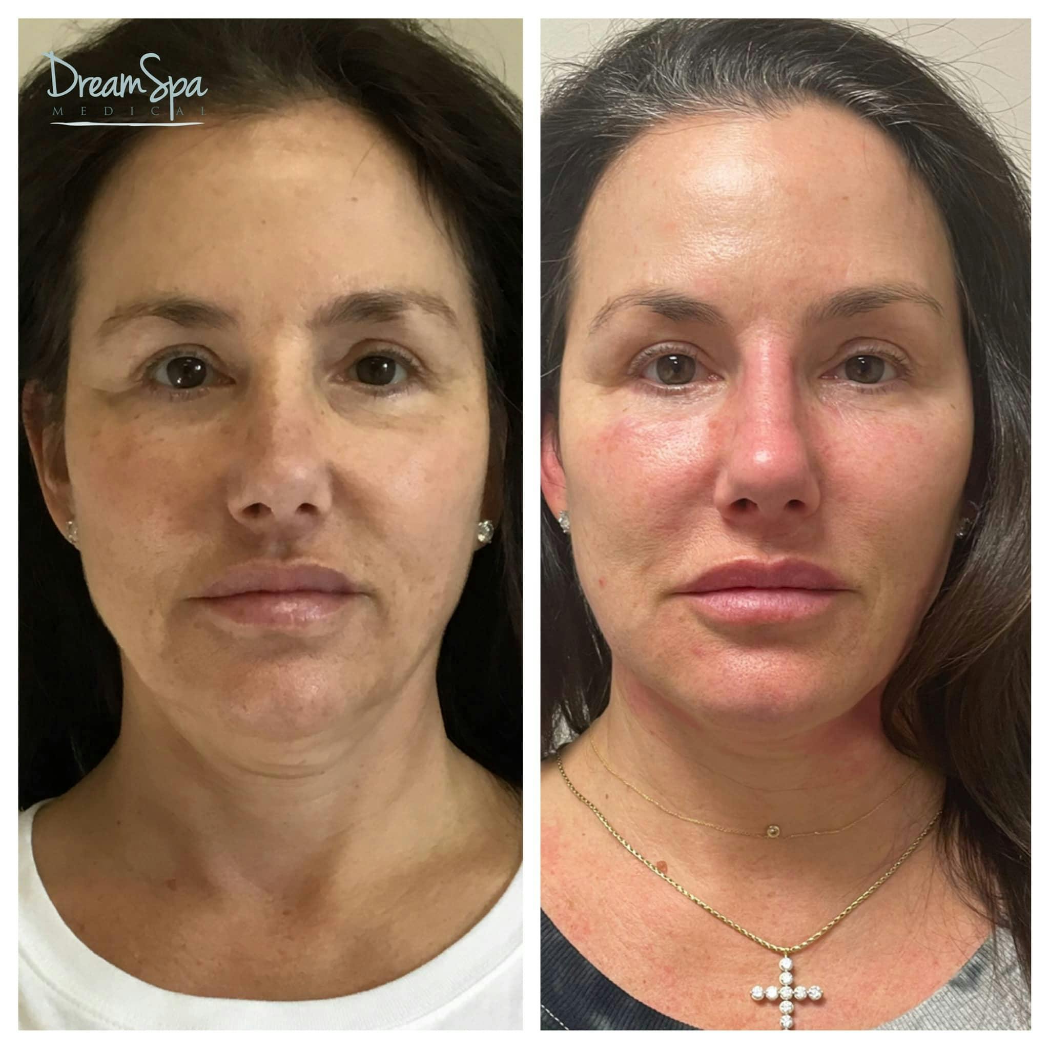 Ultherapy Before & After Gallery - Patient 118352061 - Image 1