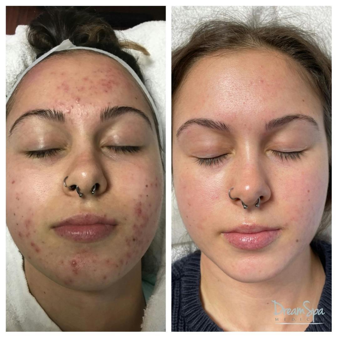 Acne Clinic Before & After Gallery - Patient 120375149 - Image 1