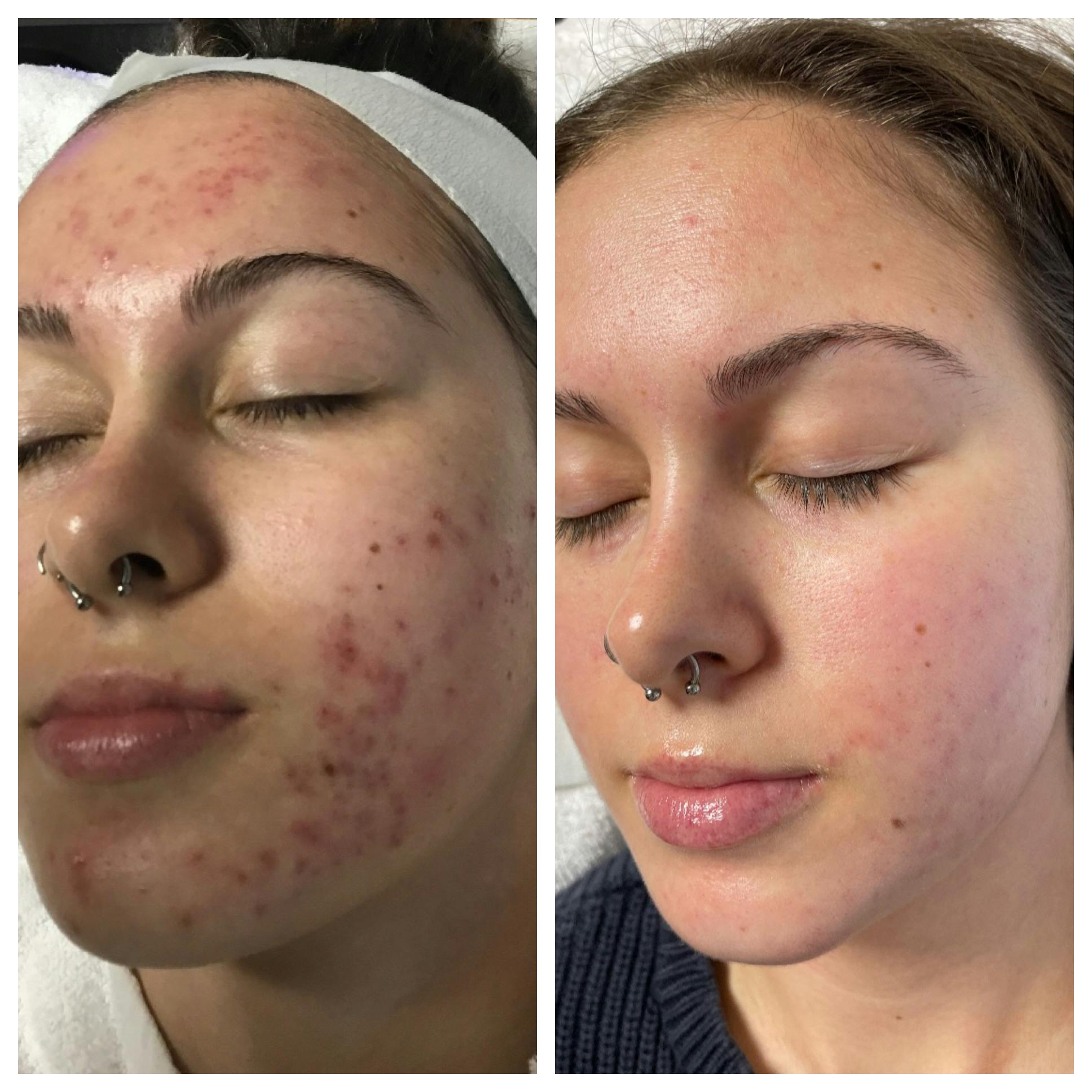 Acne Clinic Before & After Gallery - Patient 120375149 - Image 2