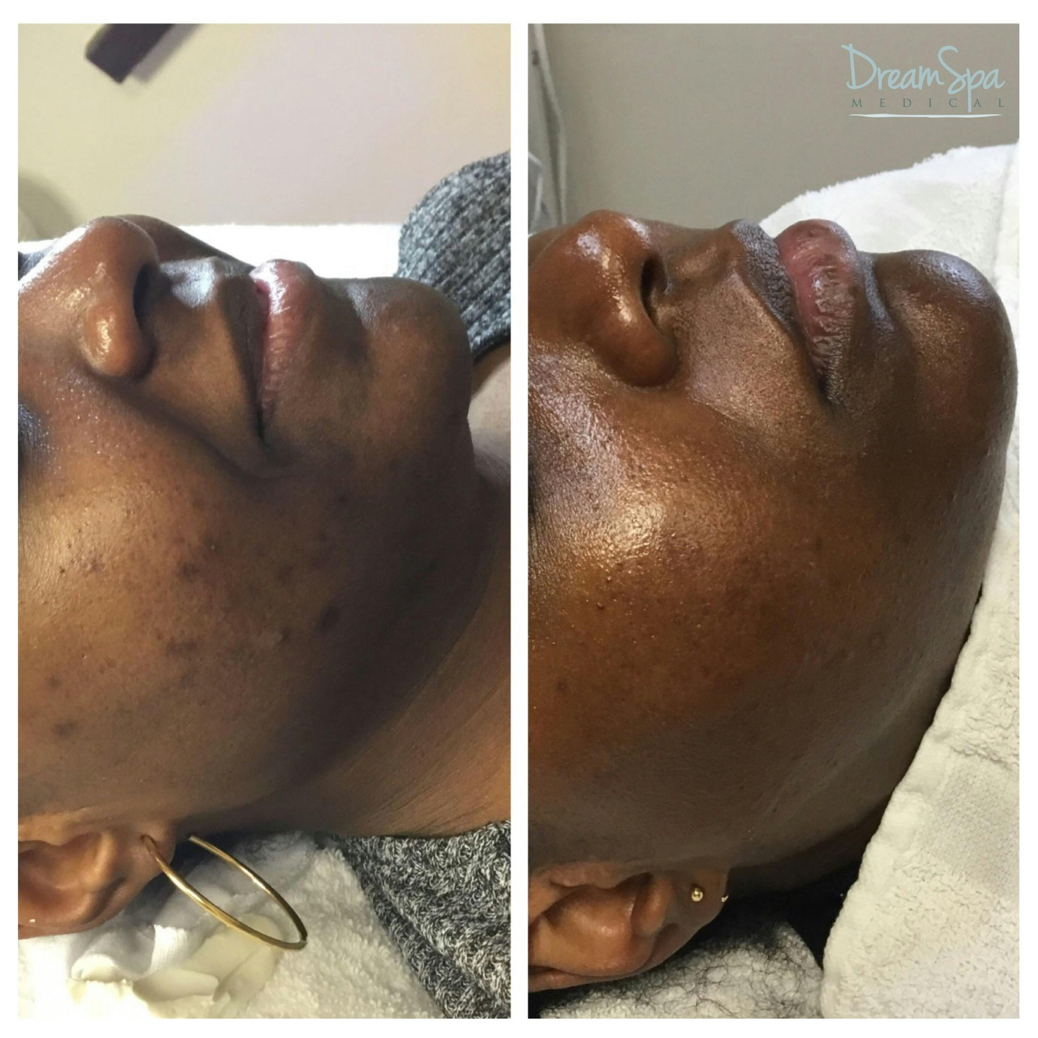 Acne Clinic Before & After Gallery - Patient 120375150 - Image 1