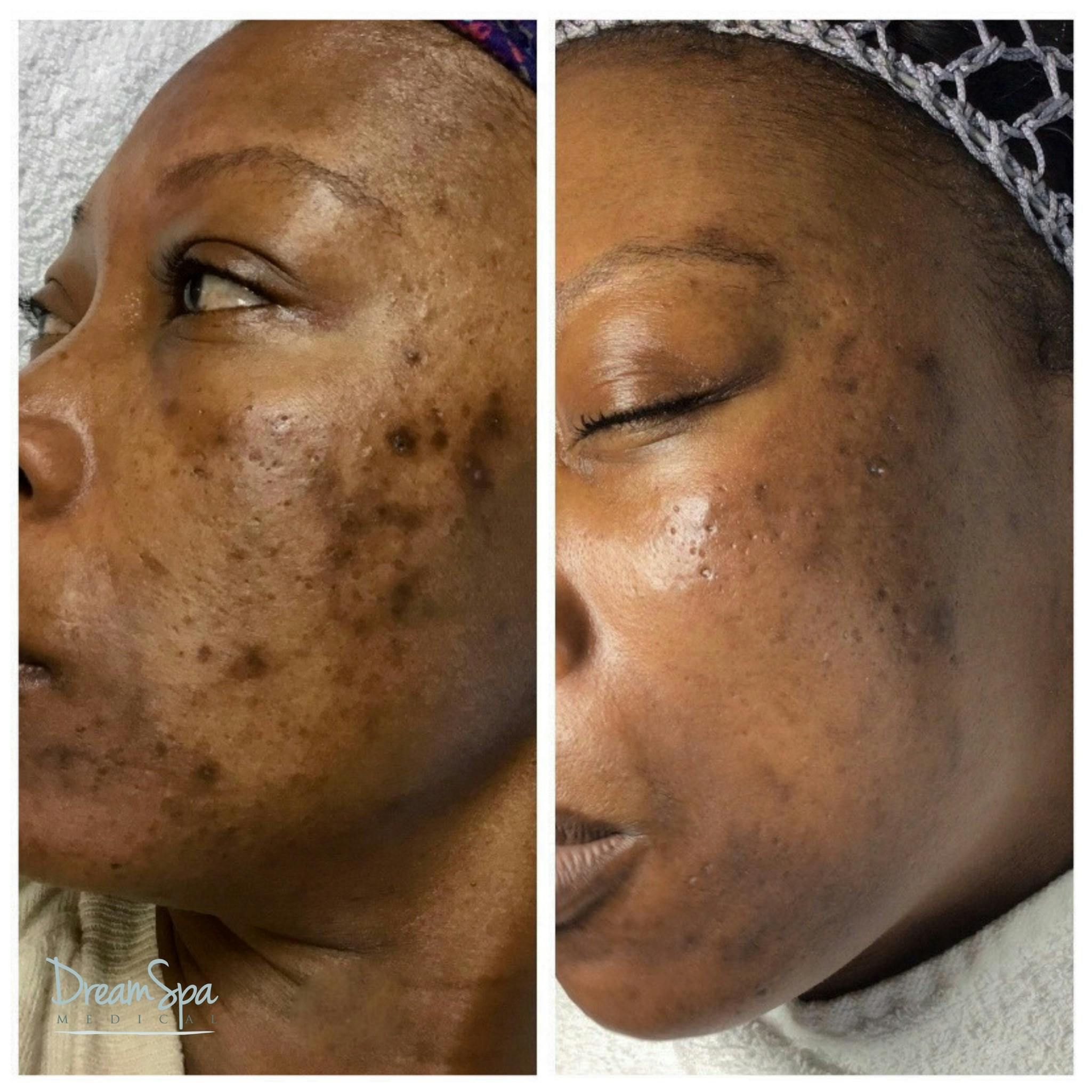 Acne Clinic Before & After Gallery - Patient 120375150 - Image 2