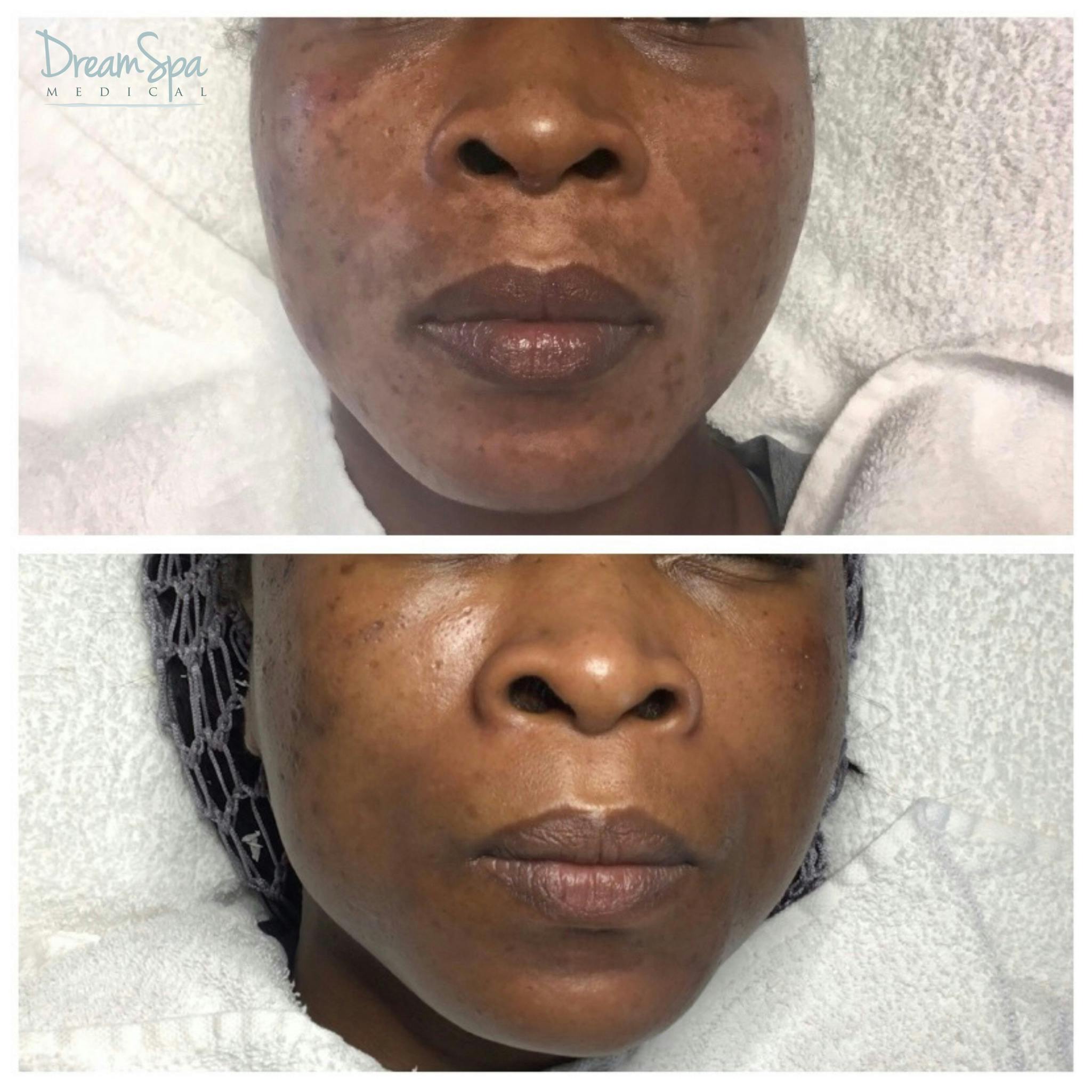 Acne Clinic Before & After Gallery - Patient 120375150 - Image 3