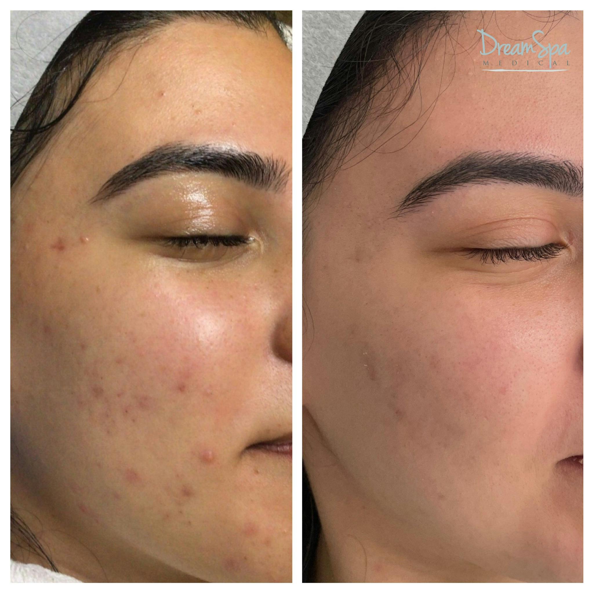 Acne Clinic Before & After Gallery - Patient 120375151 - Image 1