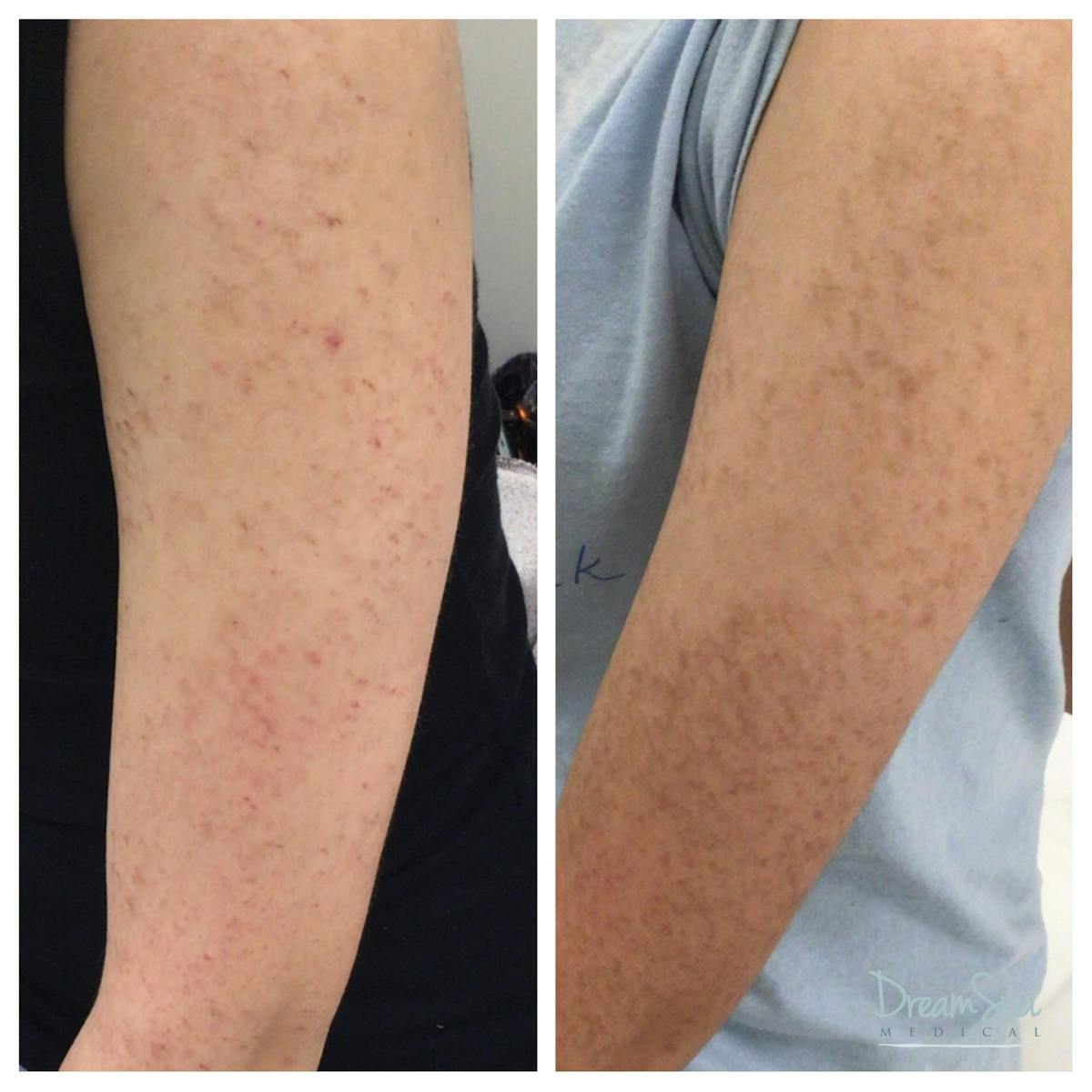 Acne Clinic Before & After Gallery - Patient 120375152 - Image 1