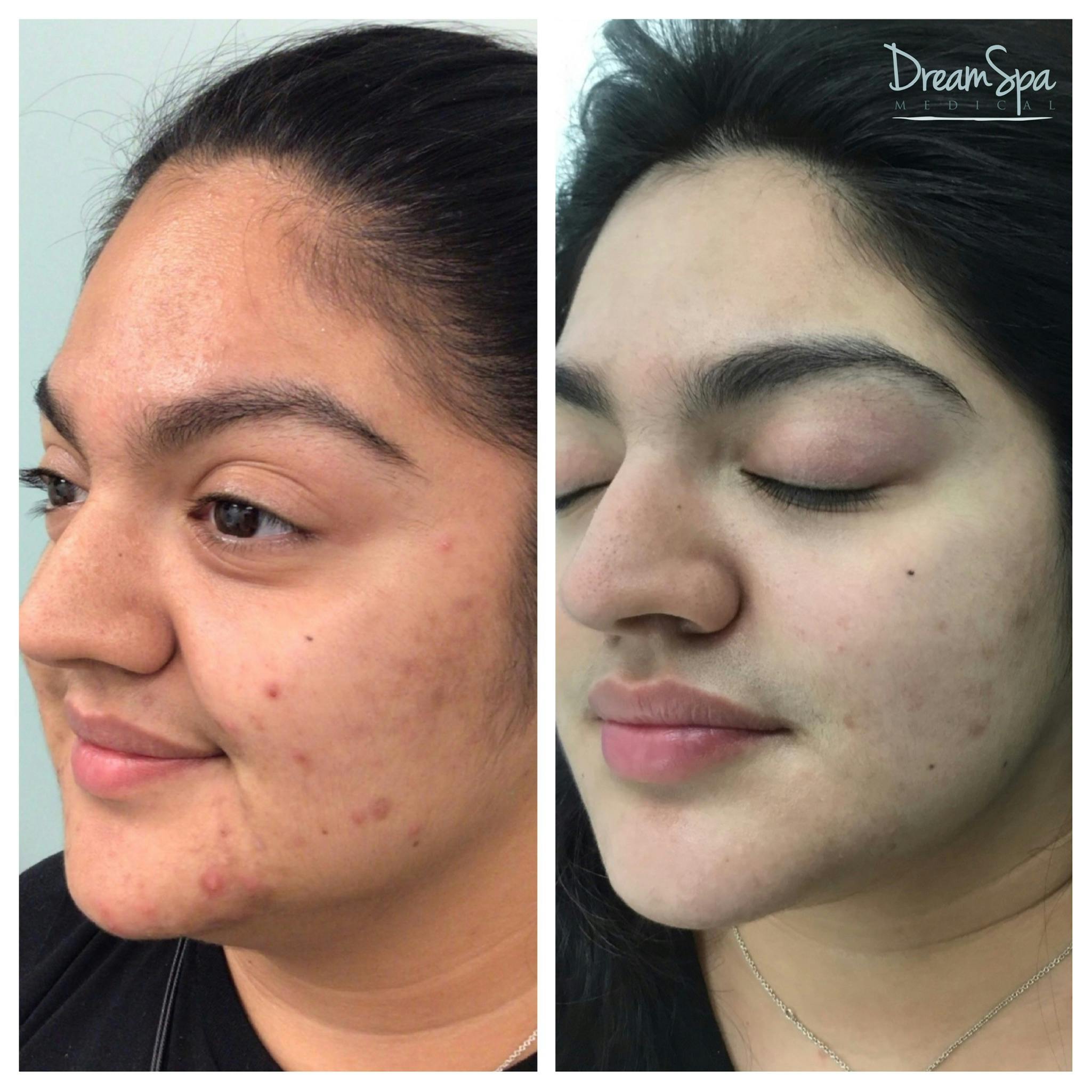 Acne Clinic Before & After Gallery - Patient 120375153 - Image 1