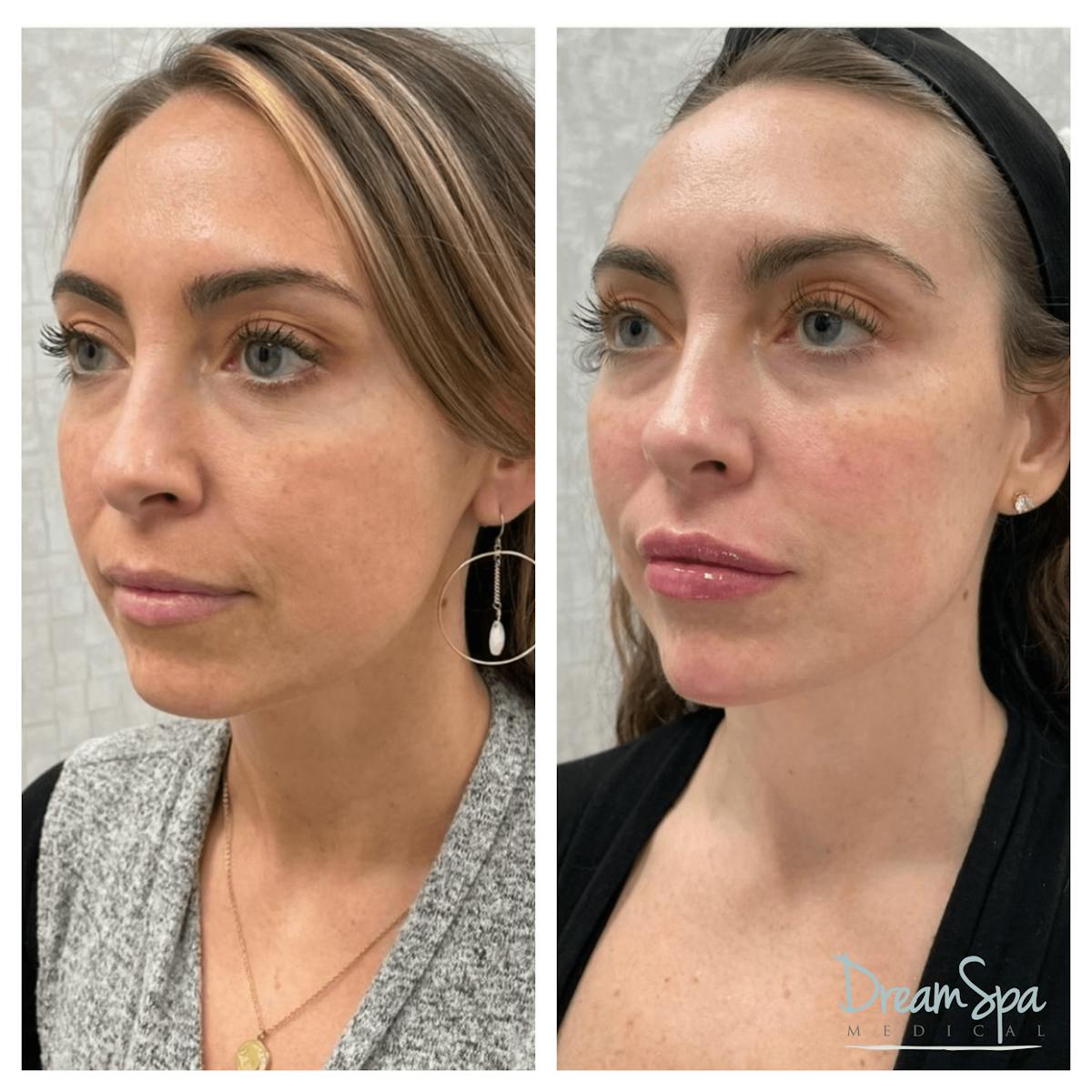 Dream Restore Before & After Gallery - Patient 121819149 - Image 1