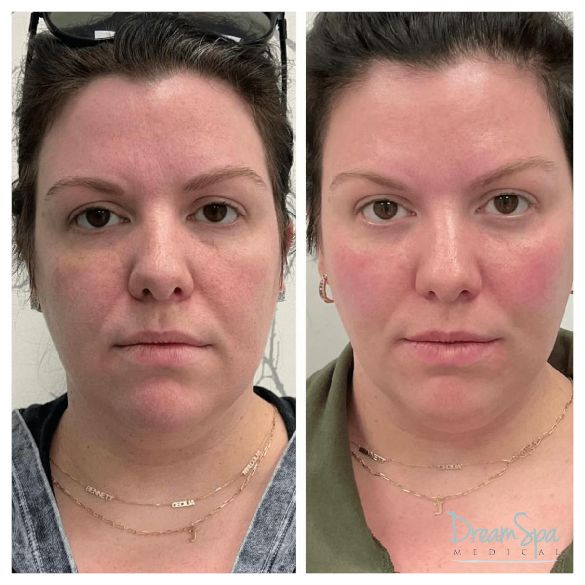 Dream Restore Before & After Gallery - Patient 121819150 - Image 1