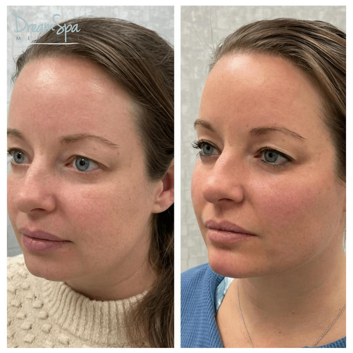 Dream Restore Before & After Gallery - Patient 121819151 - Image 1
