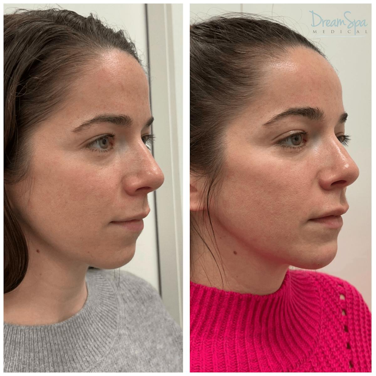 Dream Contour™ Before & After Gallery - Patient 121819188 - Image 1