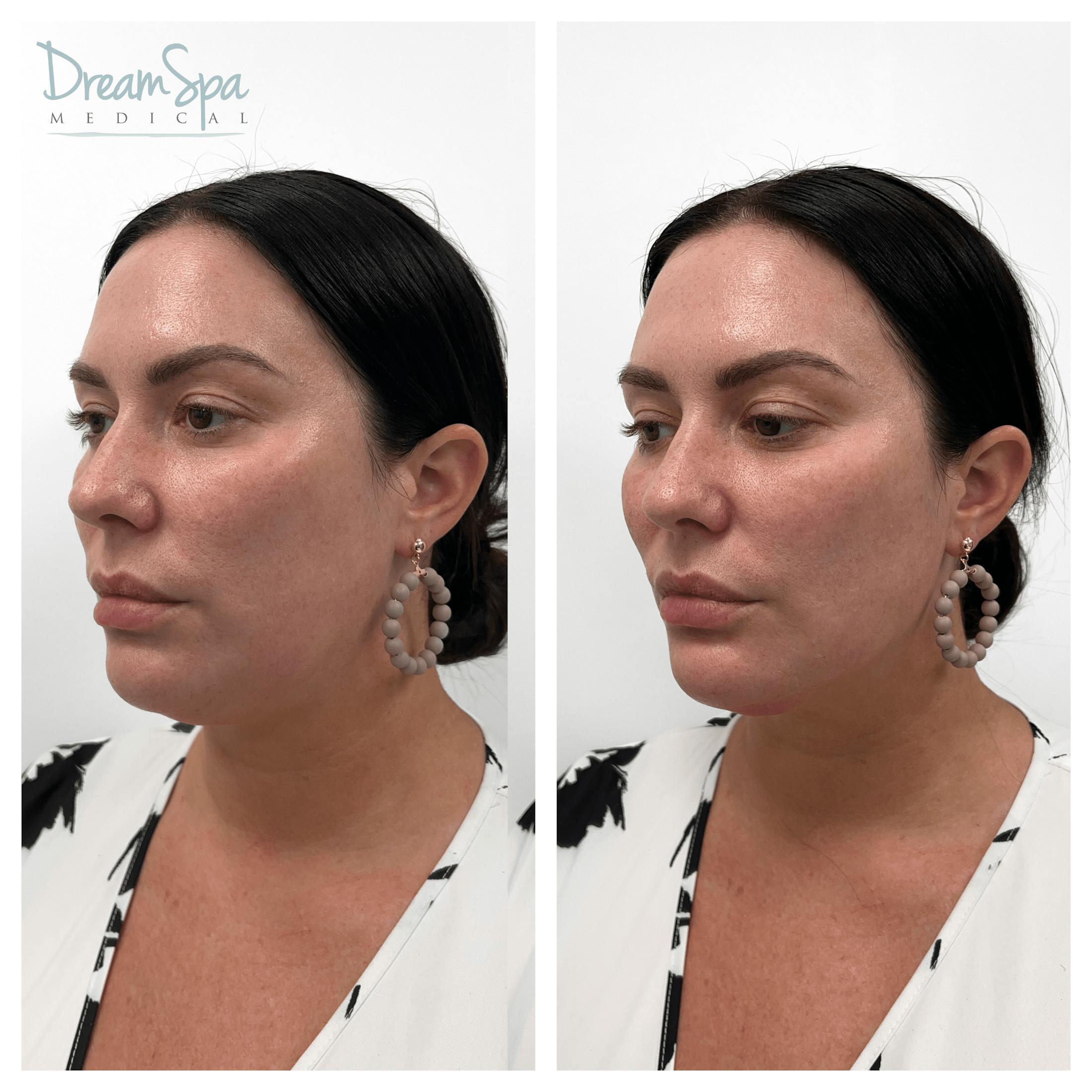 Dream Contour™ Before & After Gallery - Patient 121819187 - Image 1