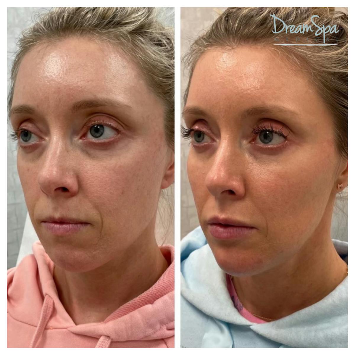 Dream Lift Before & After Gallery - Patient 121819220 - Image 1