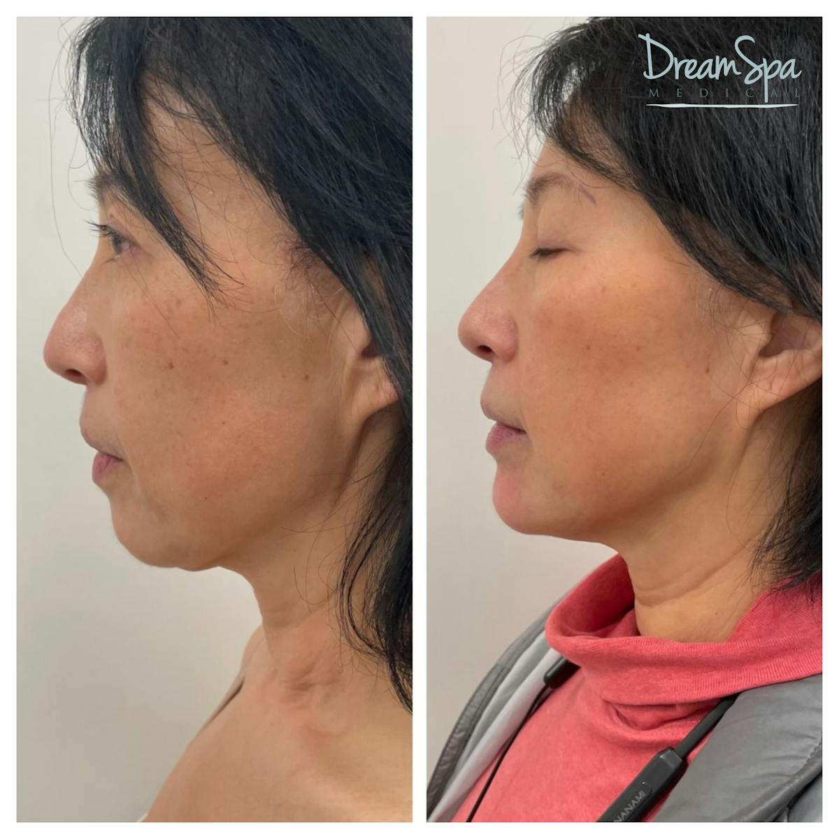 Dream Lift Before & After Gallery - Patient 121819221 - Image 1