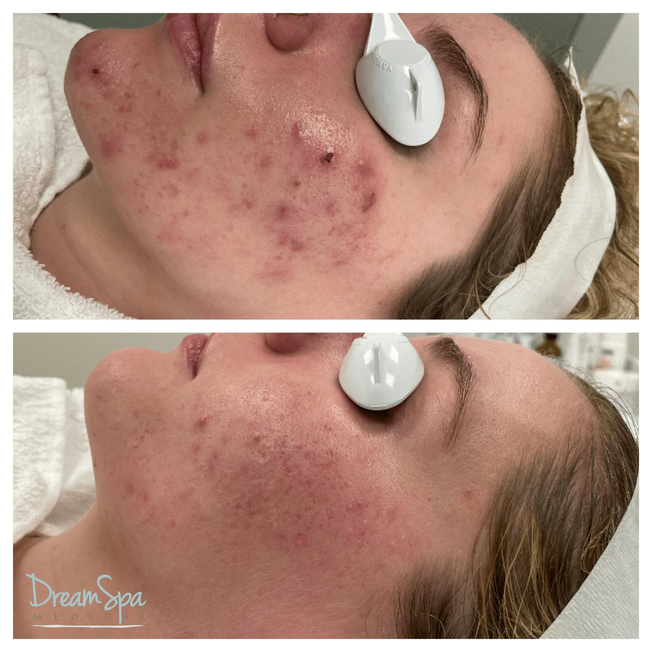 Acne Clinic Gallery - Patient 123429530 - Image 1