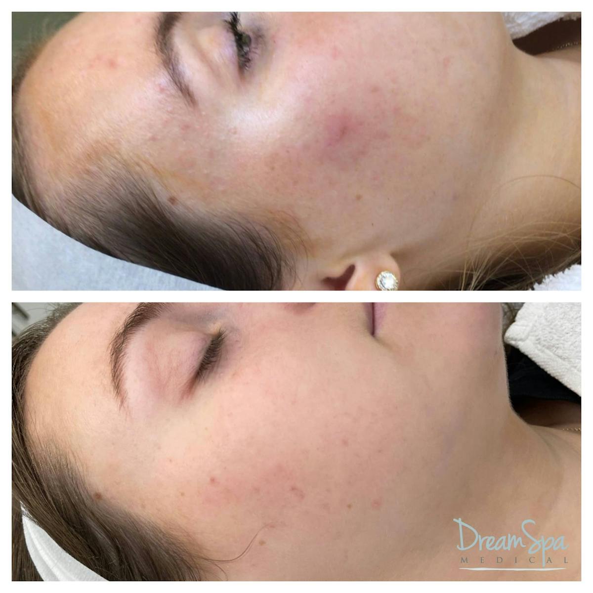 Acne Clinic Before & After Gallery - Patient 123429531 - Image 1