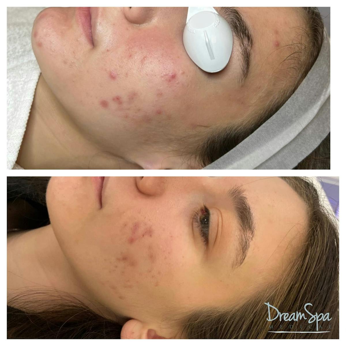 Acne Clinic Before & After Gallery - Patient 123429532 - Image 1