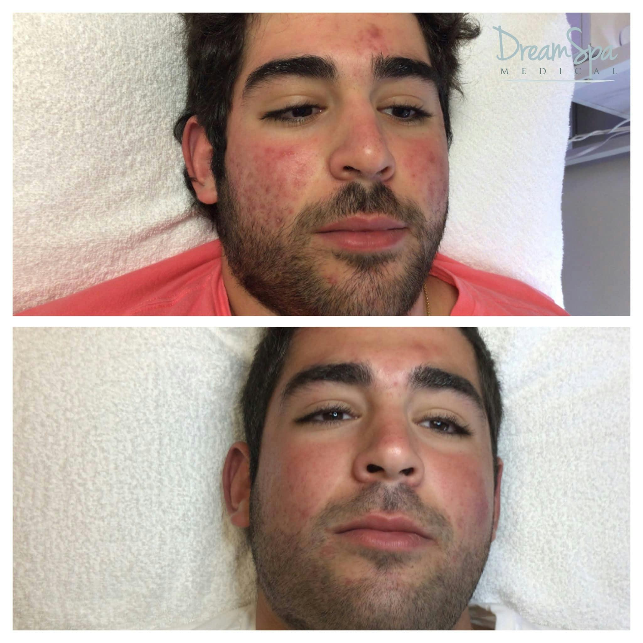 Acne Clinic Before & After Gallery - Patient 123429533 - Image 1