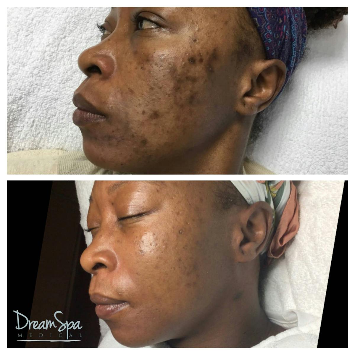 Acne Clinic Before & After Gallery - Patient 123429534 - Image 1