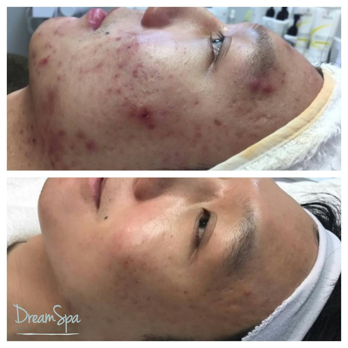 Acne Clinic Before & After Gallery - Patient 123429535 - Image 1