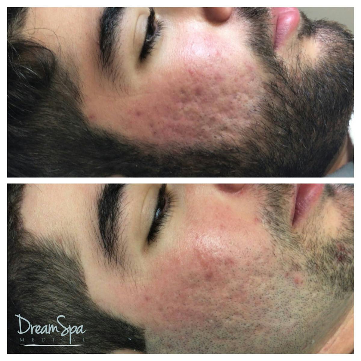 Acne Clinic Before & After Gallery - Patient 123429536 - Image 1