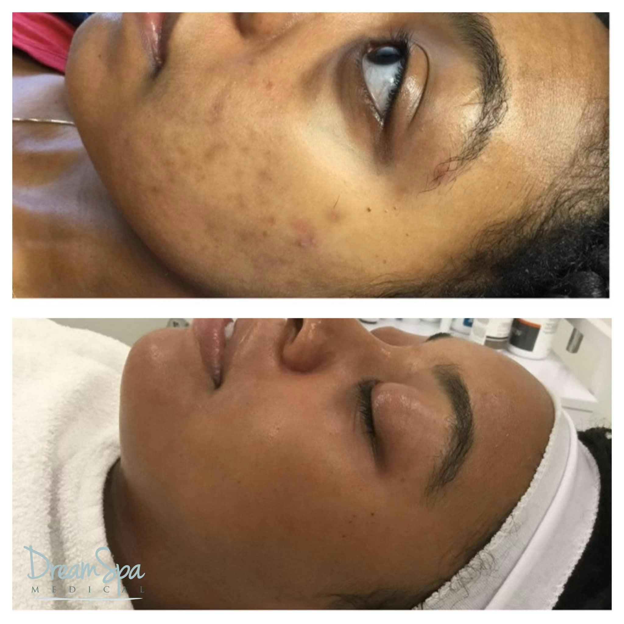 Acne Clinic Before & After Gallery - Patient 123429537 - Image 1