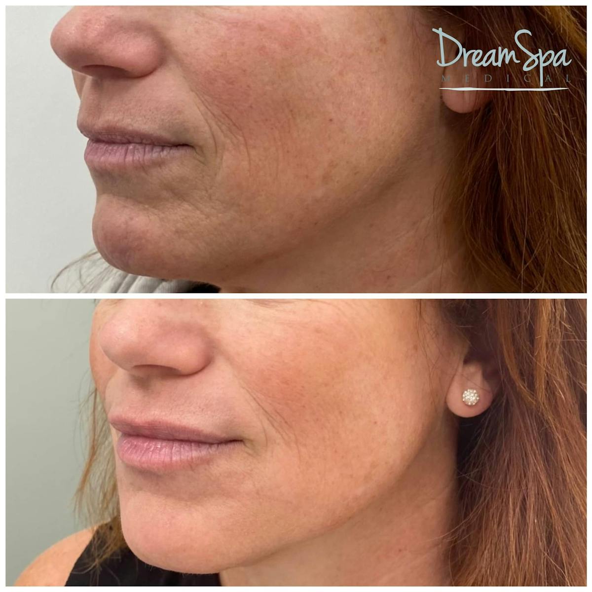 Botox Before & After Gallery - Patient 123429550 - Image 1