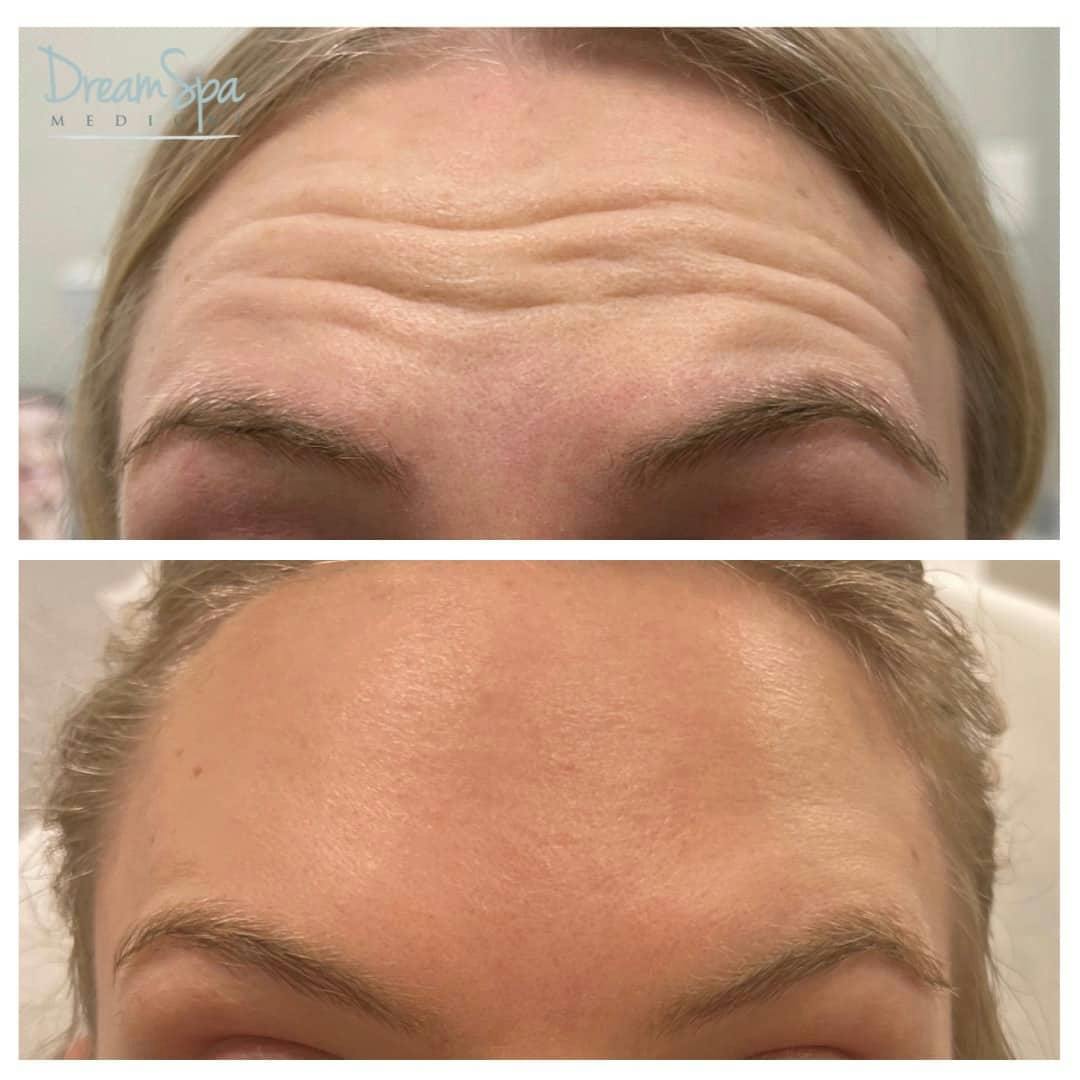 Botox Before & After Gallery - Patient 123429551 - Image 1