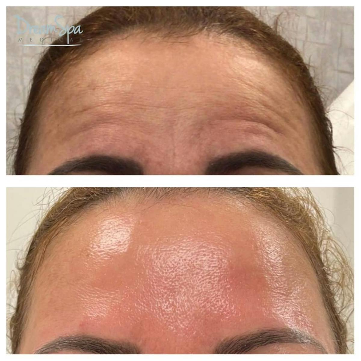 Botox Before & After Gallery - Patient 123429552 - Image 1