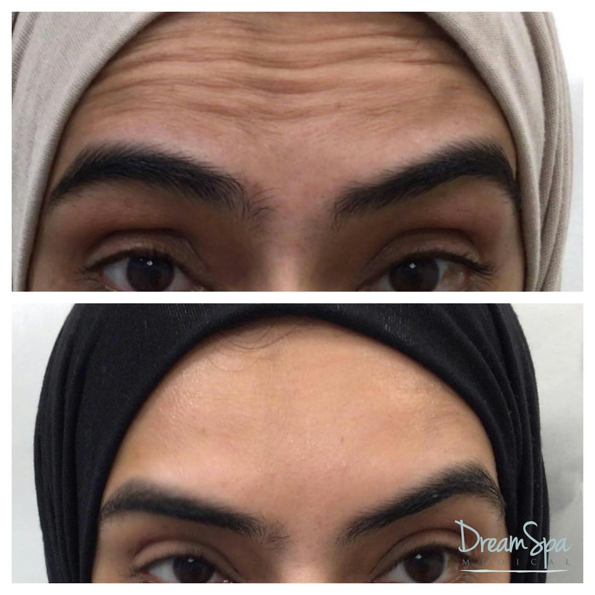 Botox Before & After Gallery - Patient 123429553 - Image 1
