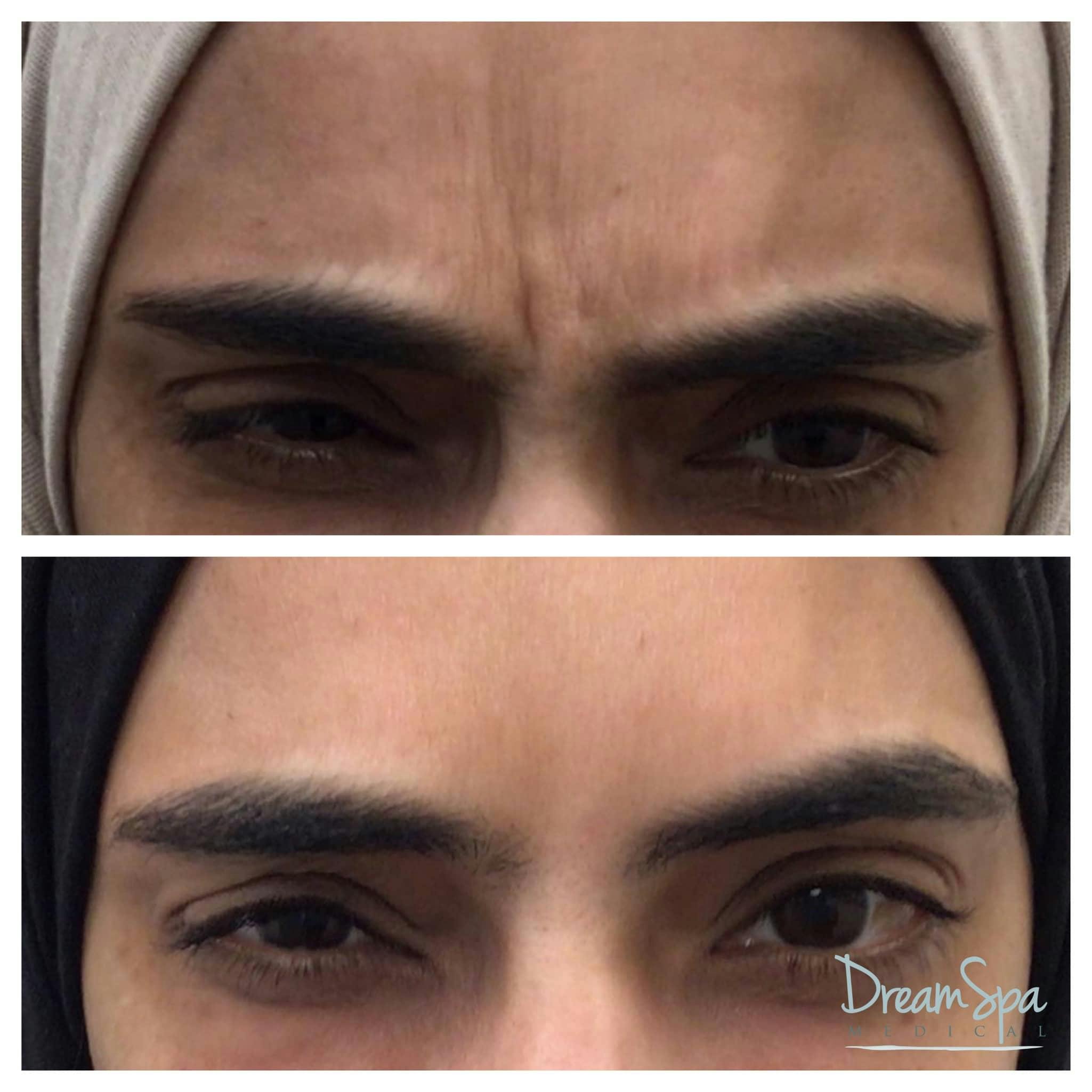 Botox Before & After Gallery - Patient 123429553 - Image 2