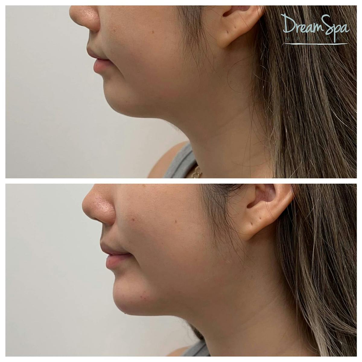 Chin Filler Before & After Gallery - Patient 123429578 - Image 1