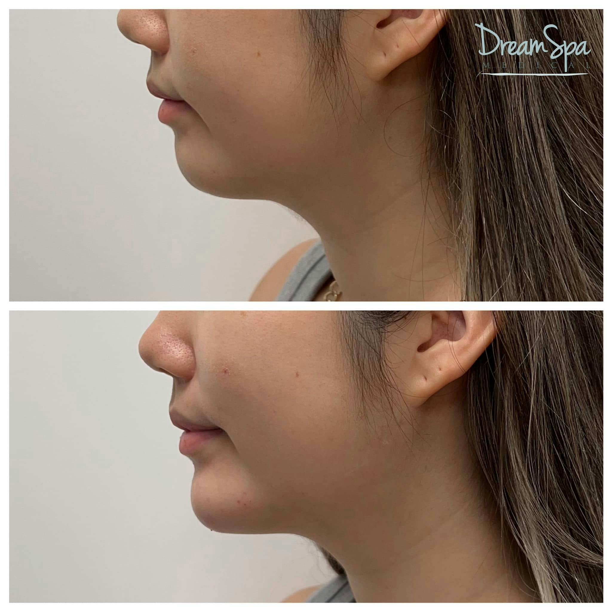 Chin Filler Before & After Gallery - Patient 123429578 - Image 1