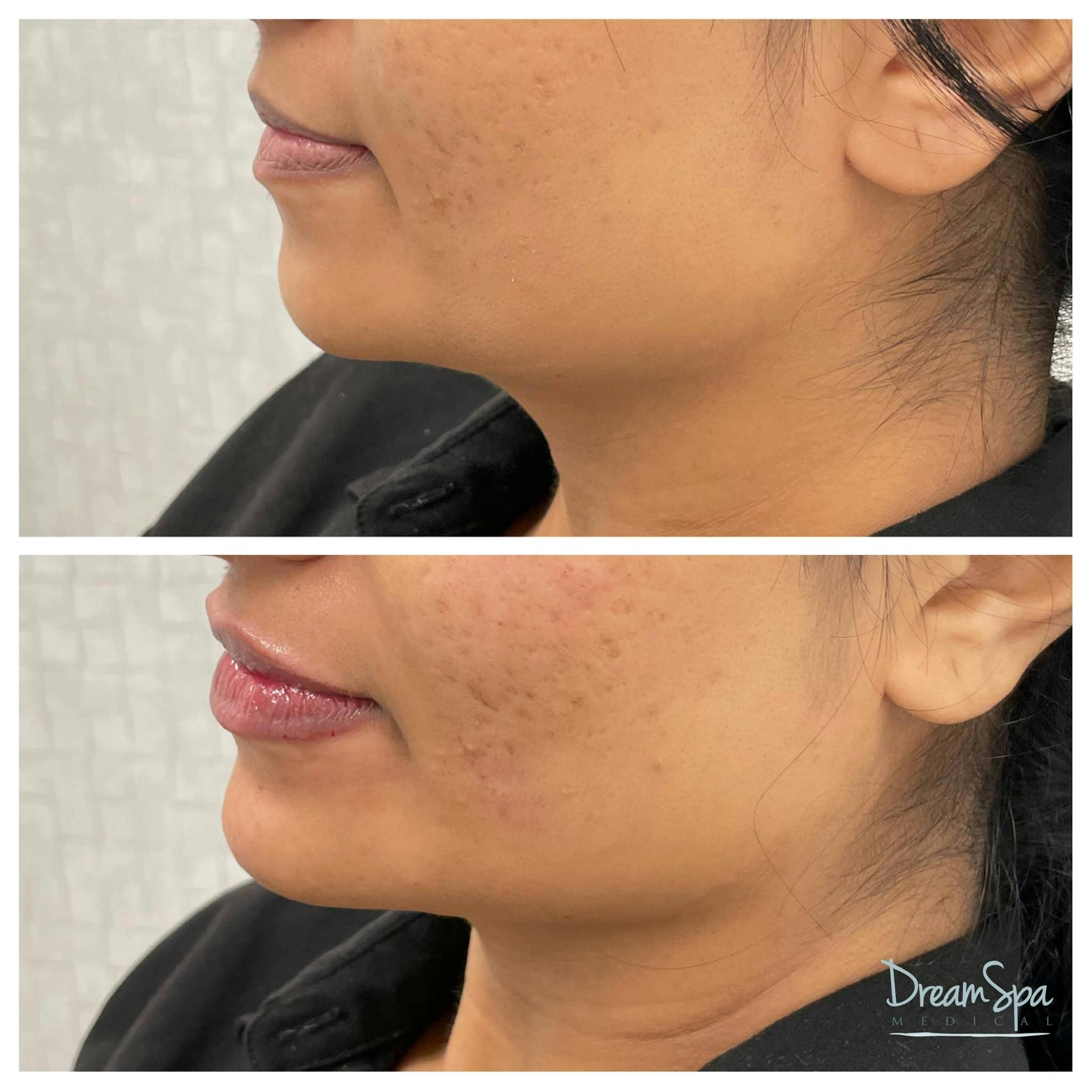 Chin Filler Before & After Gallery - Patient 123429579 - Image 1