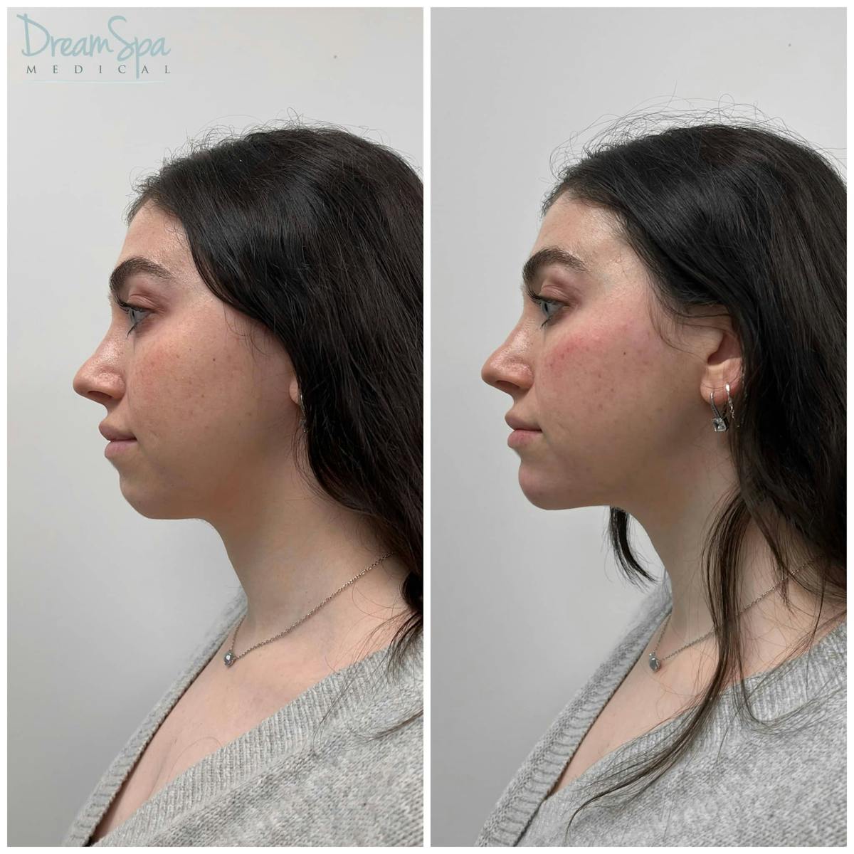 Chin Filler Before & After Gallery - Patient 123429580 - Image 1