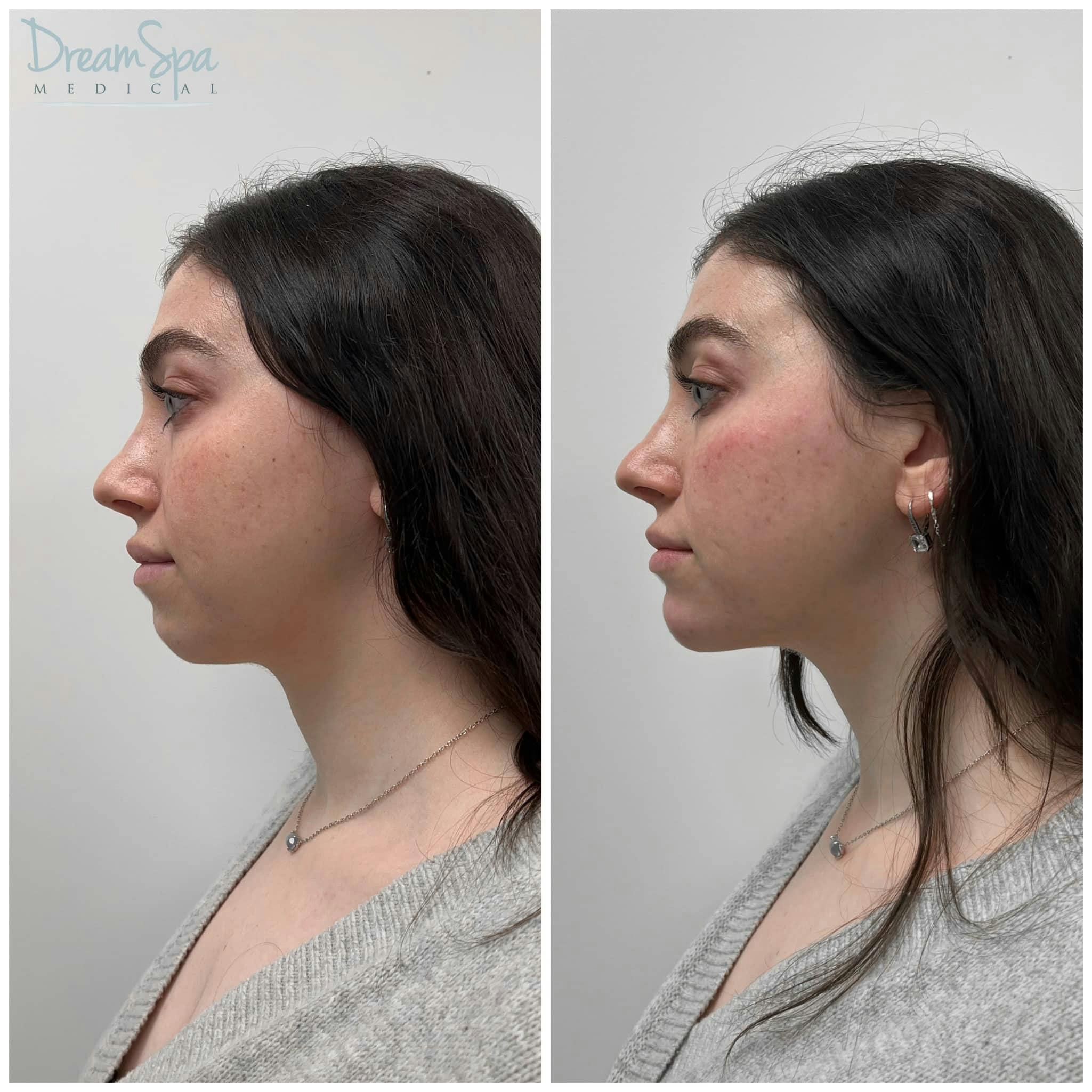 Chin Filler Gallery - Patient 123429580 - Image 1