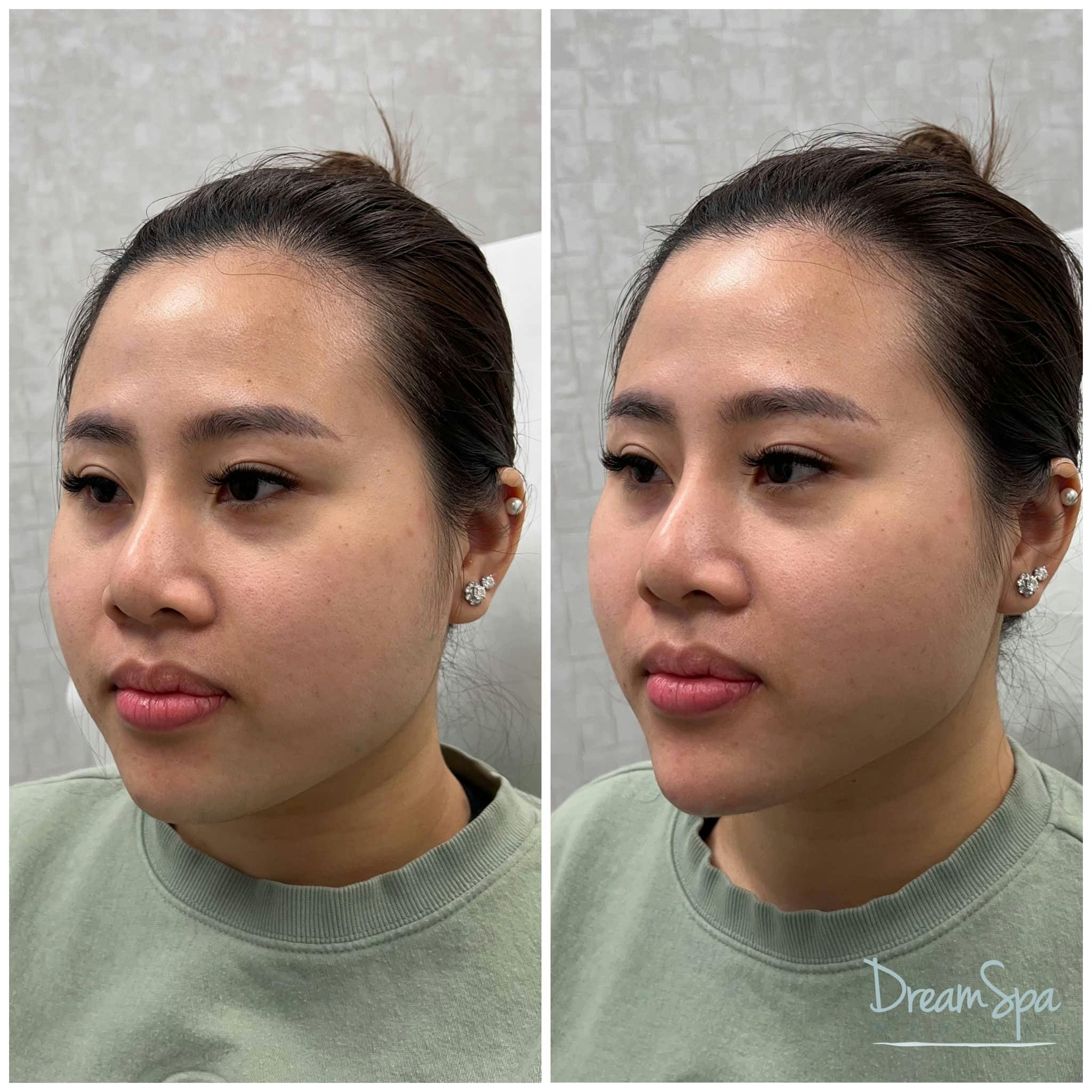 Chin Filler Before & After Gallery - Patient 123429581 - Image 1