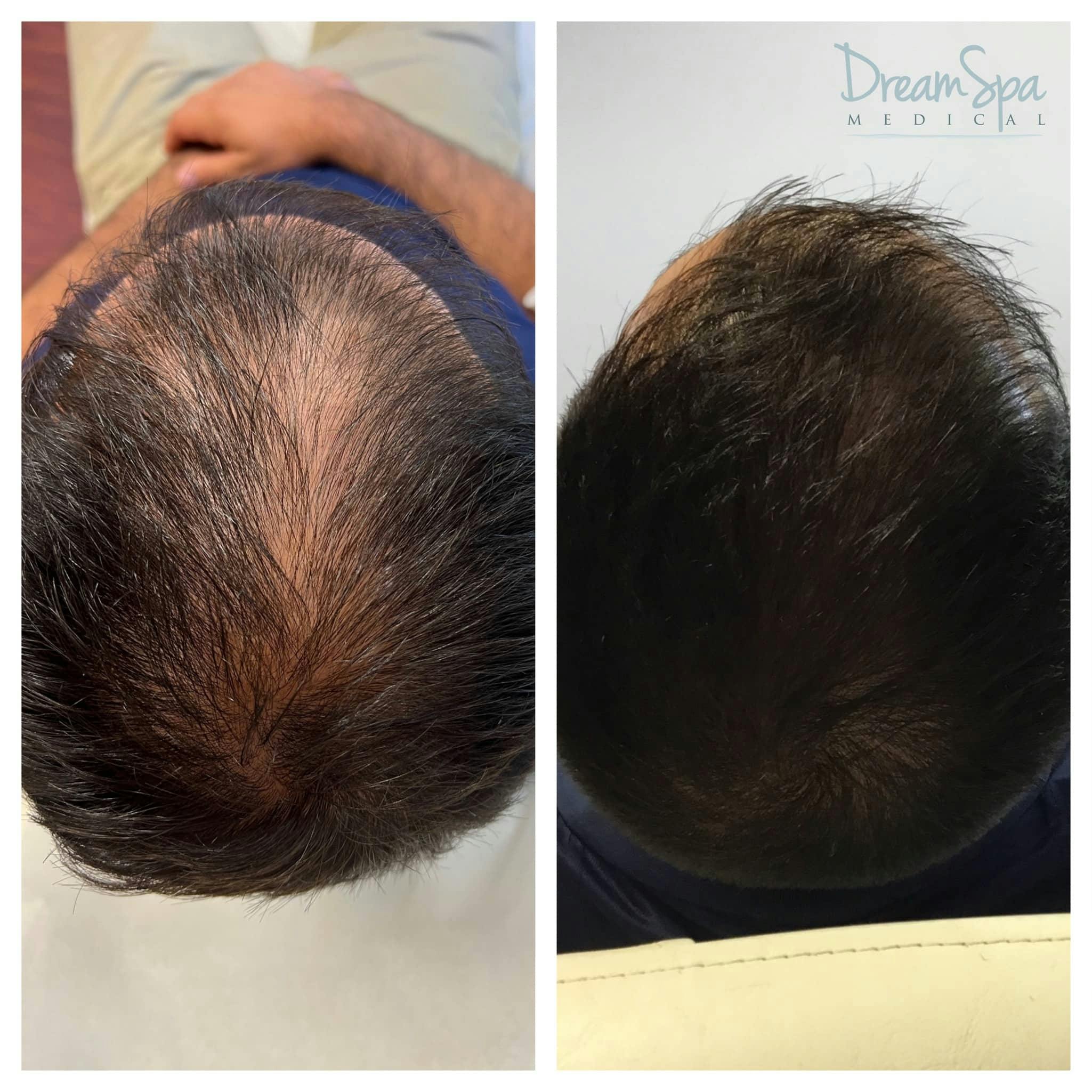 Hair Restoration Before & After