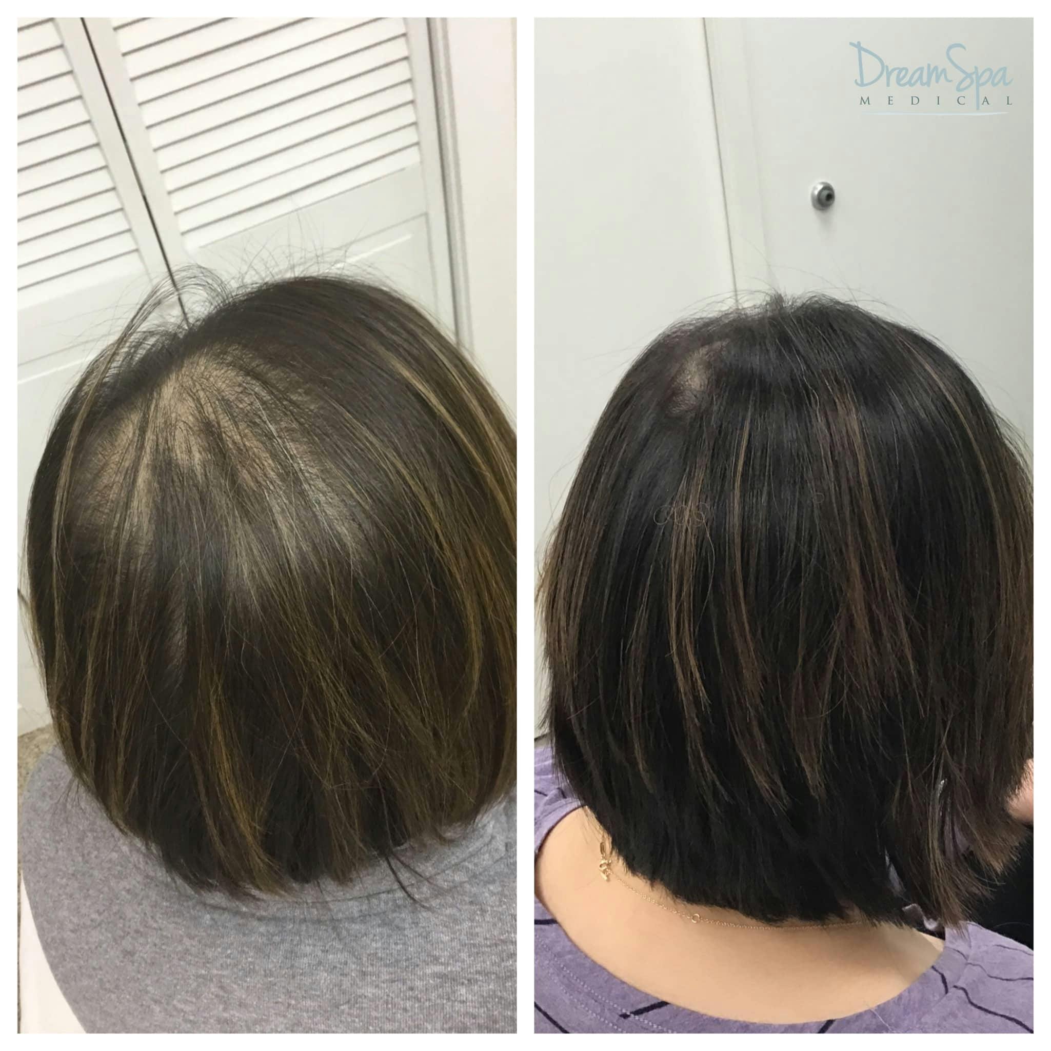 Hair Restoration Before & After