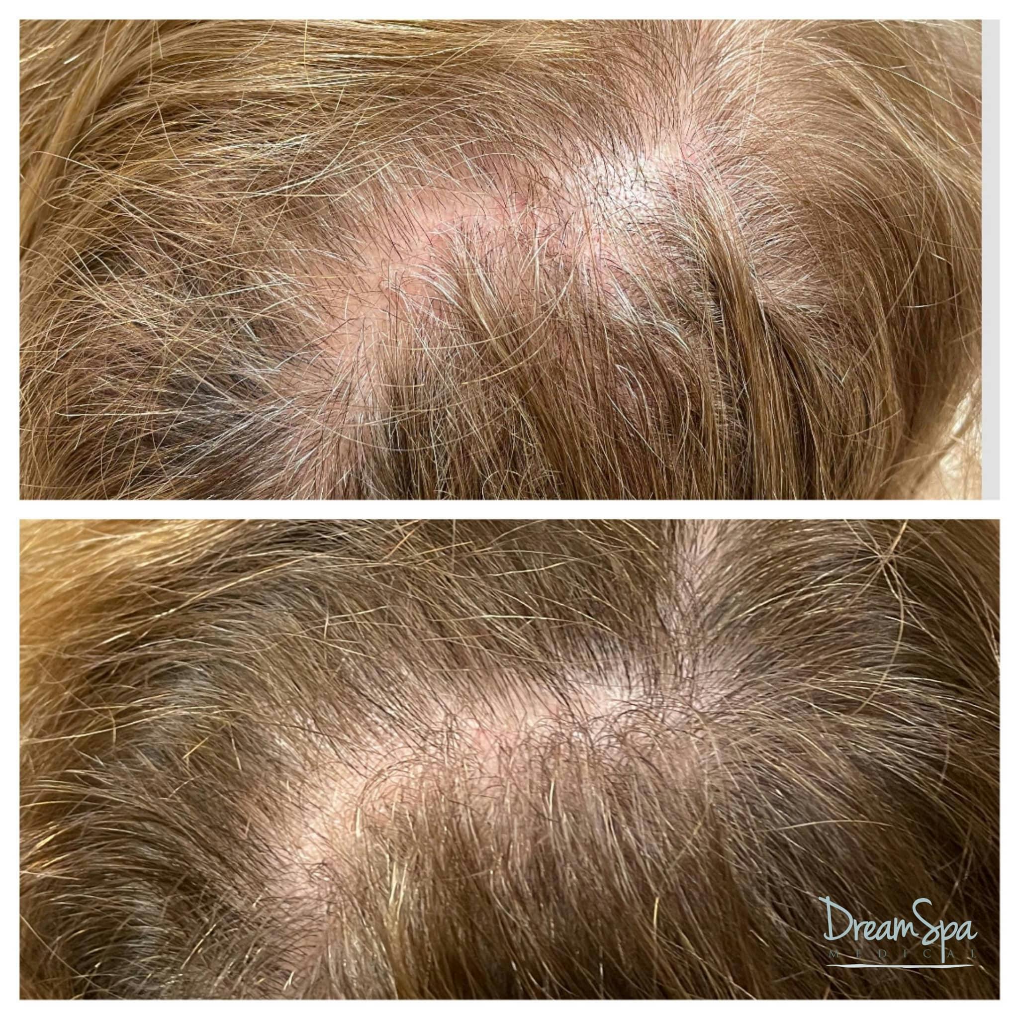 Hair Restoration Before & After Gallery - Patient 123429616 - Image 1