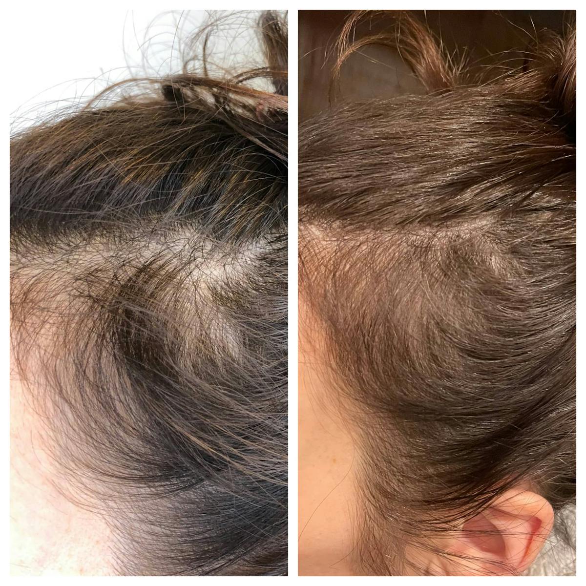 Hair Restoration Before & After Gallery - Patient 123429617 - Image 1