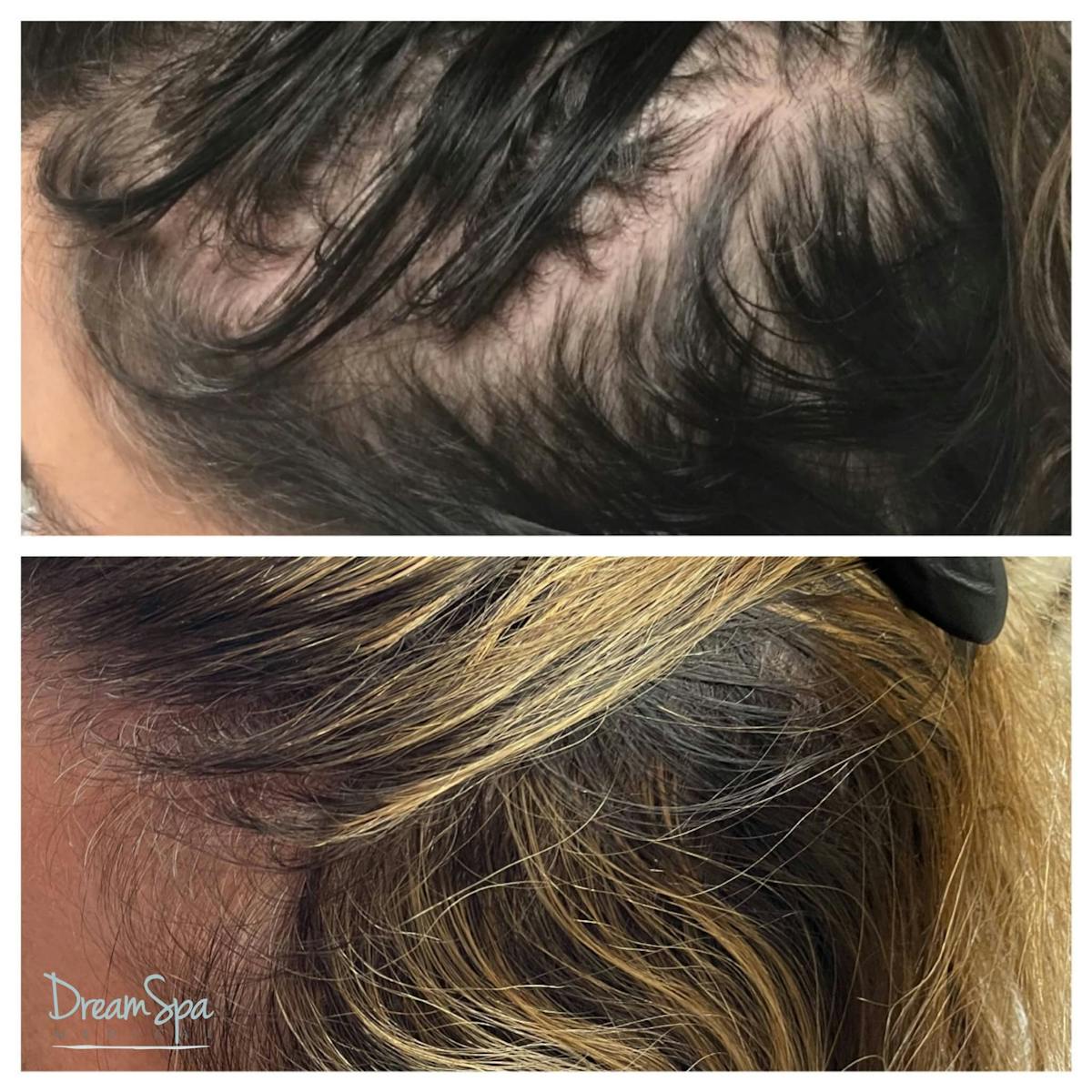 Hair Restoration Before & After Gallery - Patient 123429618 - Image 1